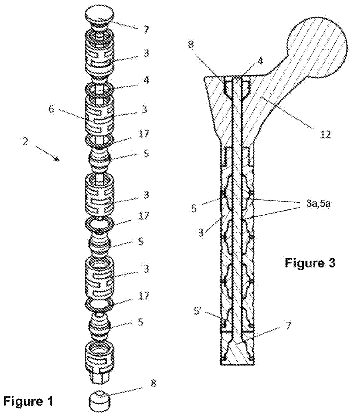 Intramedullary Fixation Device Eureka Patsnap Develop Intelligence