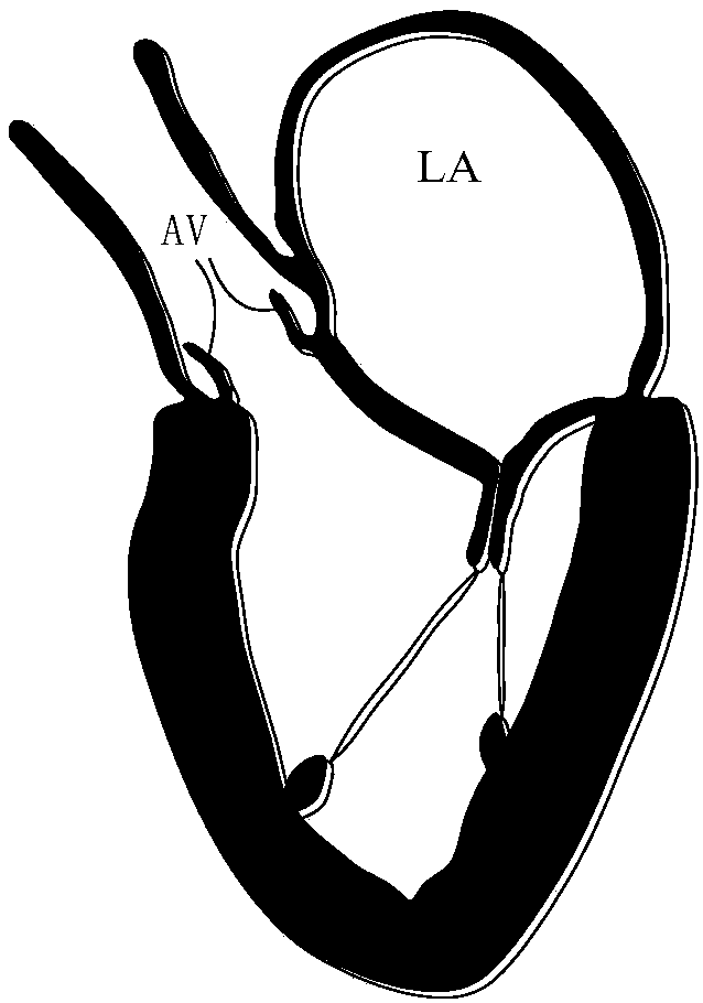 Artificial Chordae Tendineae Implantation System With Position