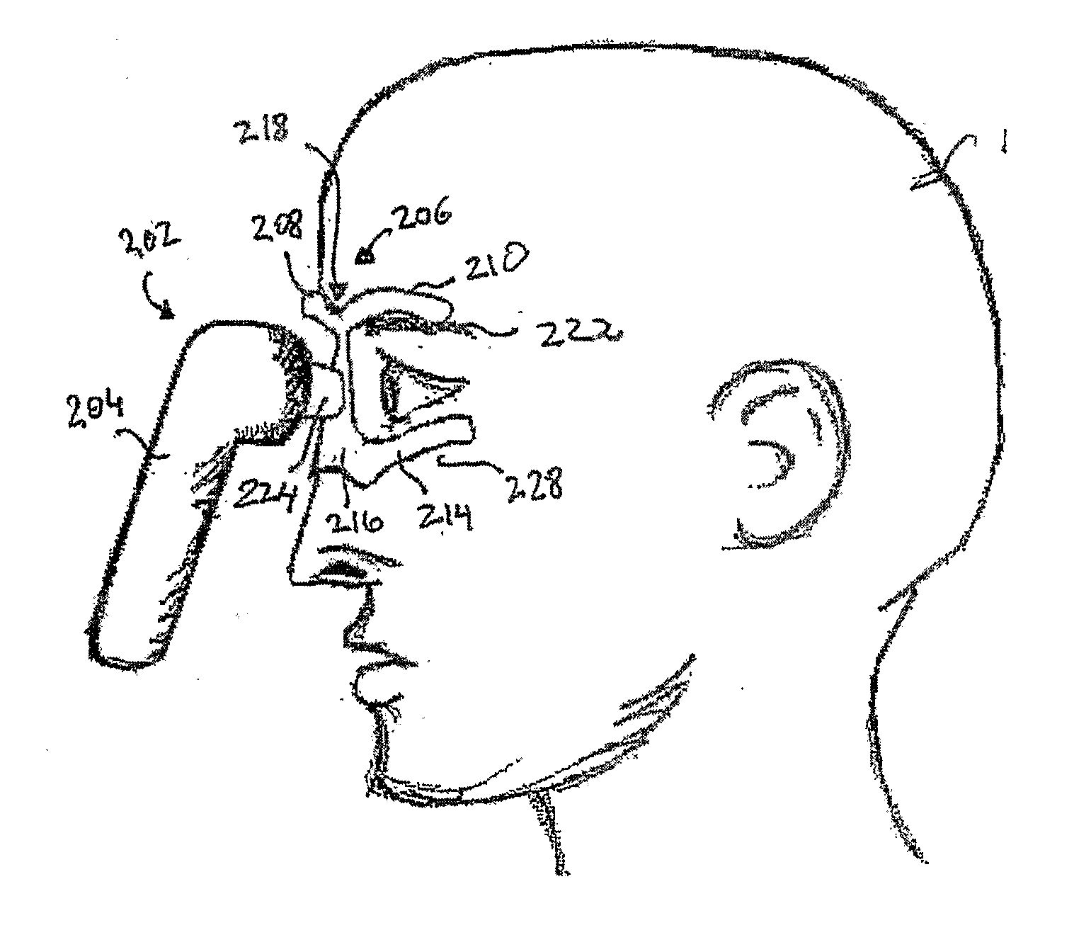 Vibrating Device For Treating Nasal Congestion and Sinusitis Symptoms and Method Thereof