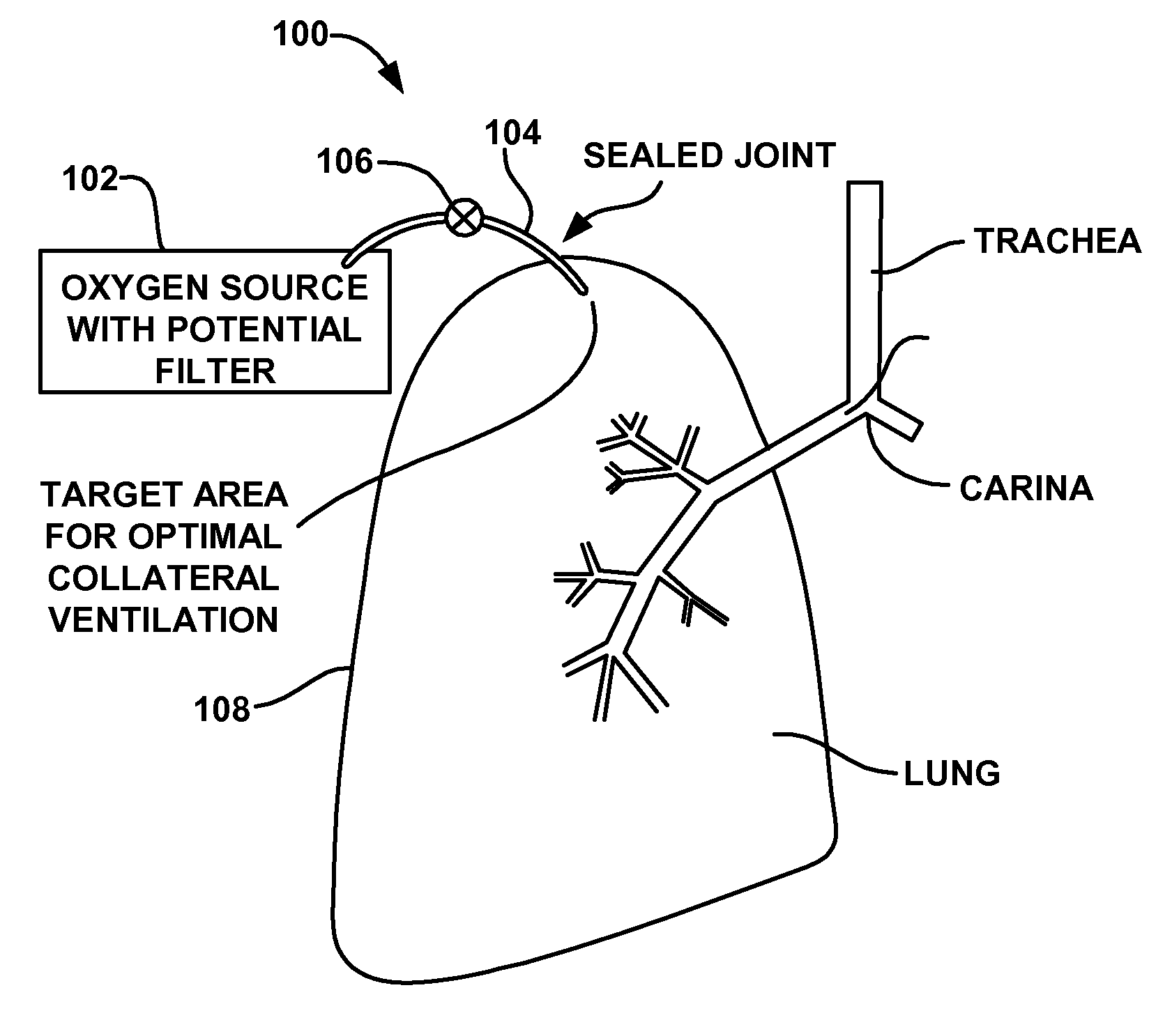 Device and method for creating a localized pleurodesis and treating a lung through the localized pleurodesis
