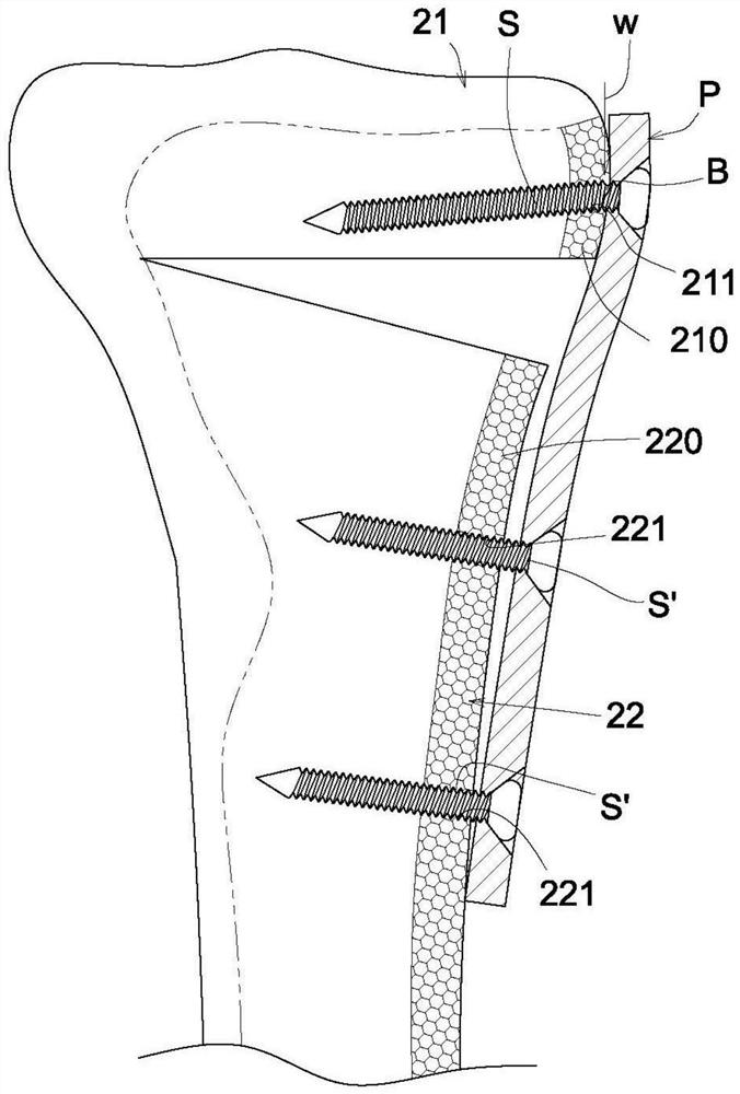Stable fixing bone plate for high tibia osteotomy