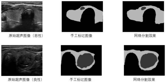 A diagnosis method of thyroid nodules based on deep learning network