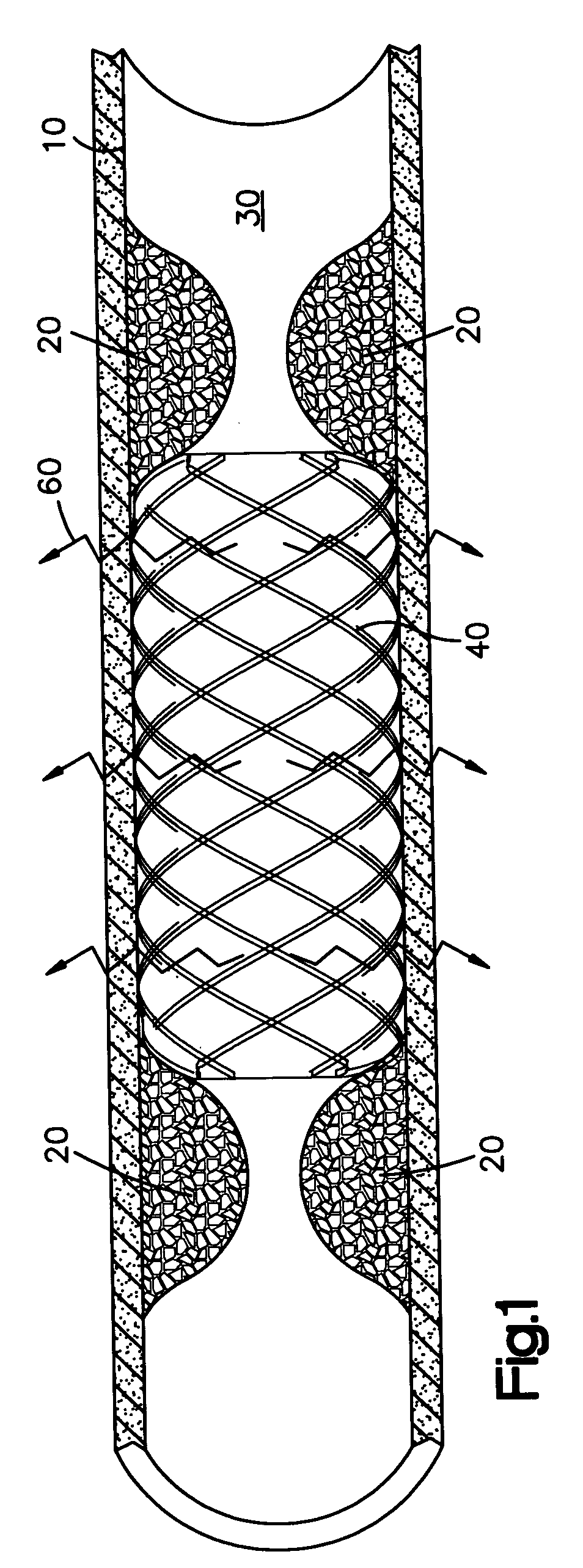 System for administering a combination of therapies to a body lumen