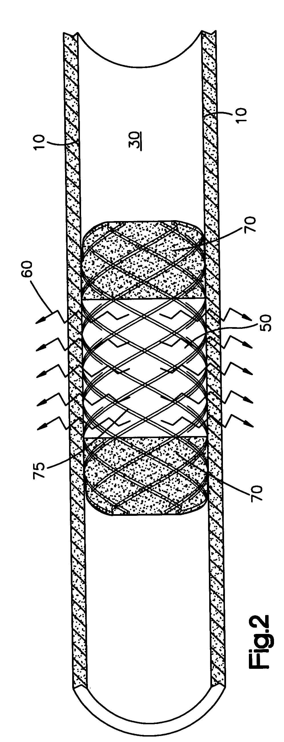 System for administering a combination of therapies to a body lumen