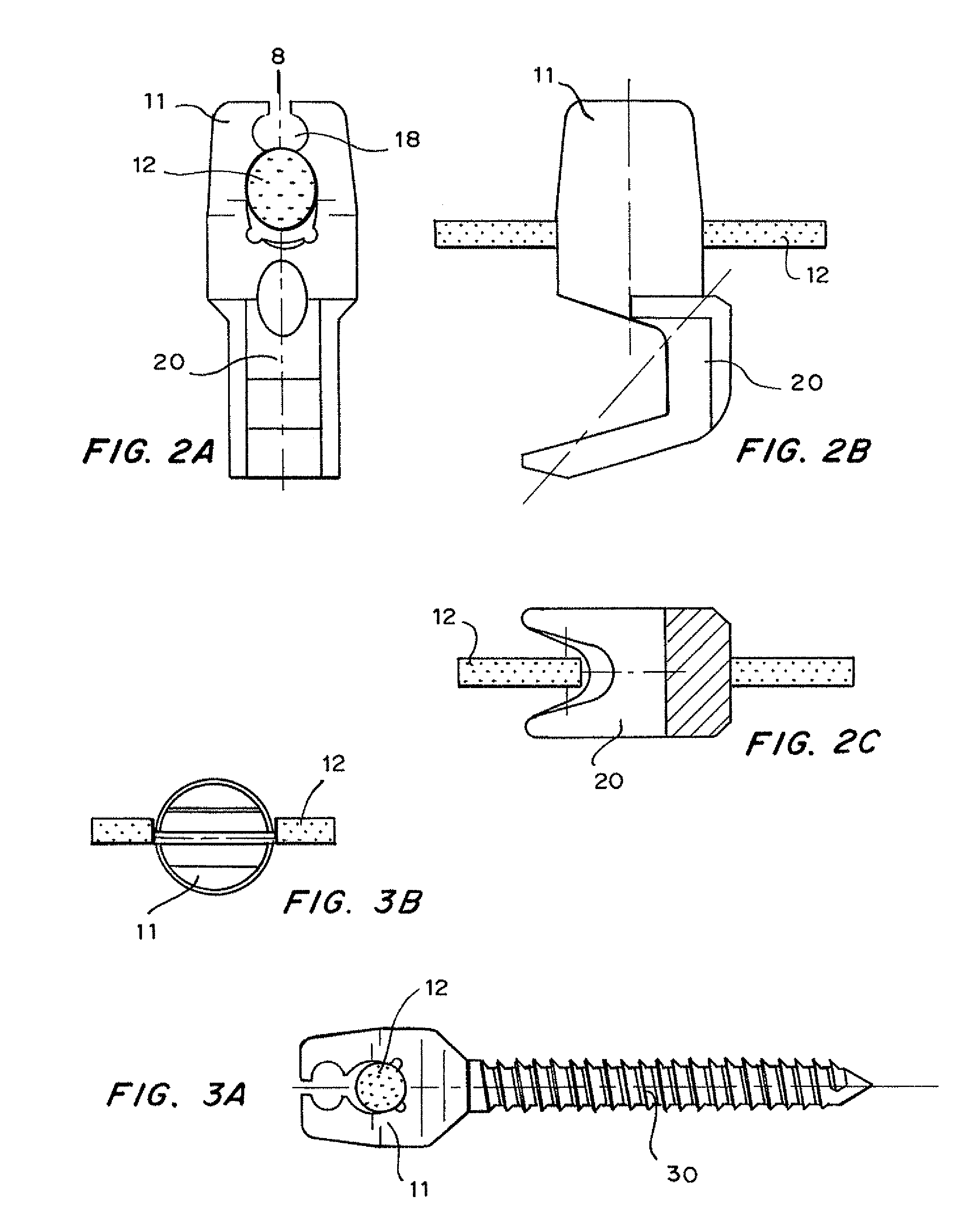 Shape memory locking device for orthopedic implants