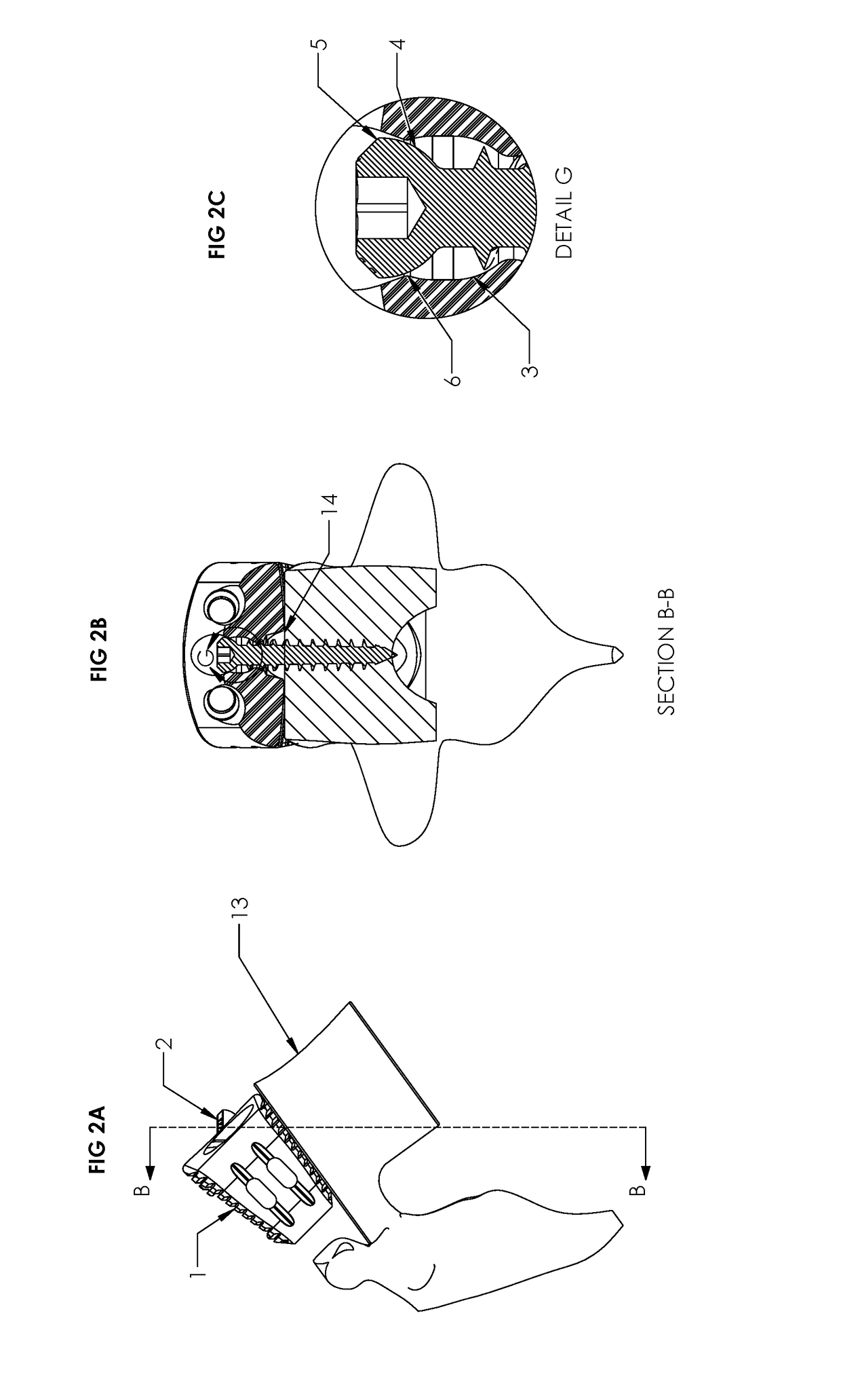 Spinal Implant with Screw Retention and Removal Mechanisms