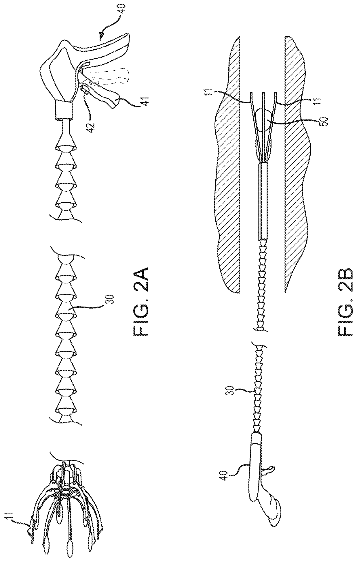 Medical device to remove an obstruction from a body lumen, vessel or organ