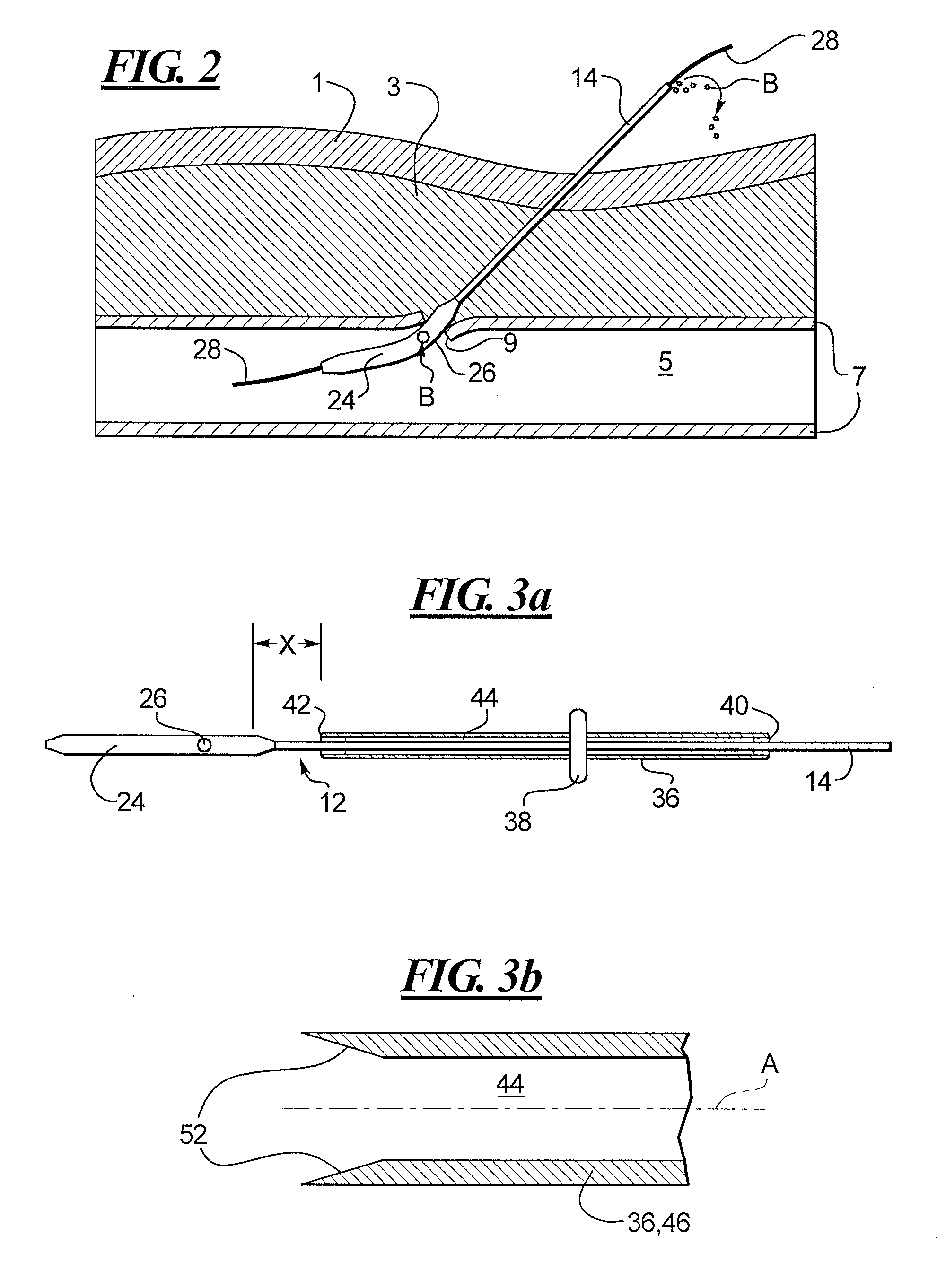 Depth and puncture control for system for hemostasis of blood vessel