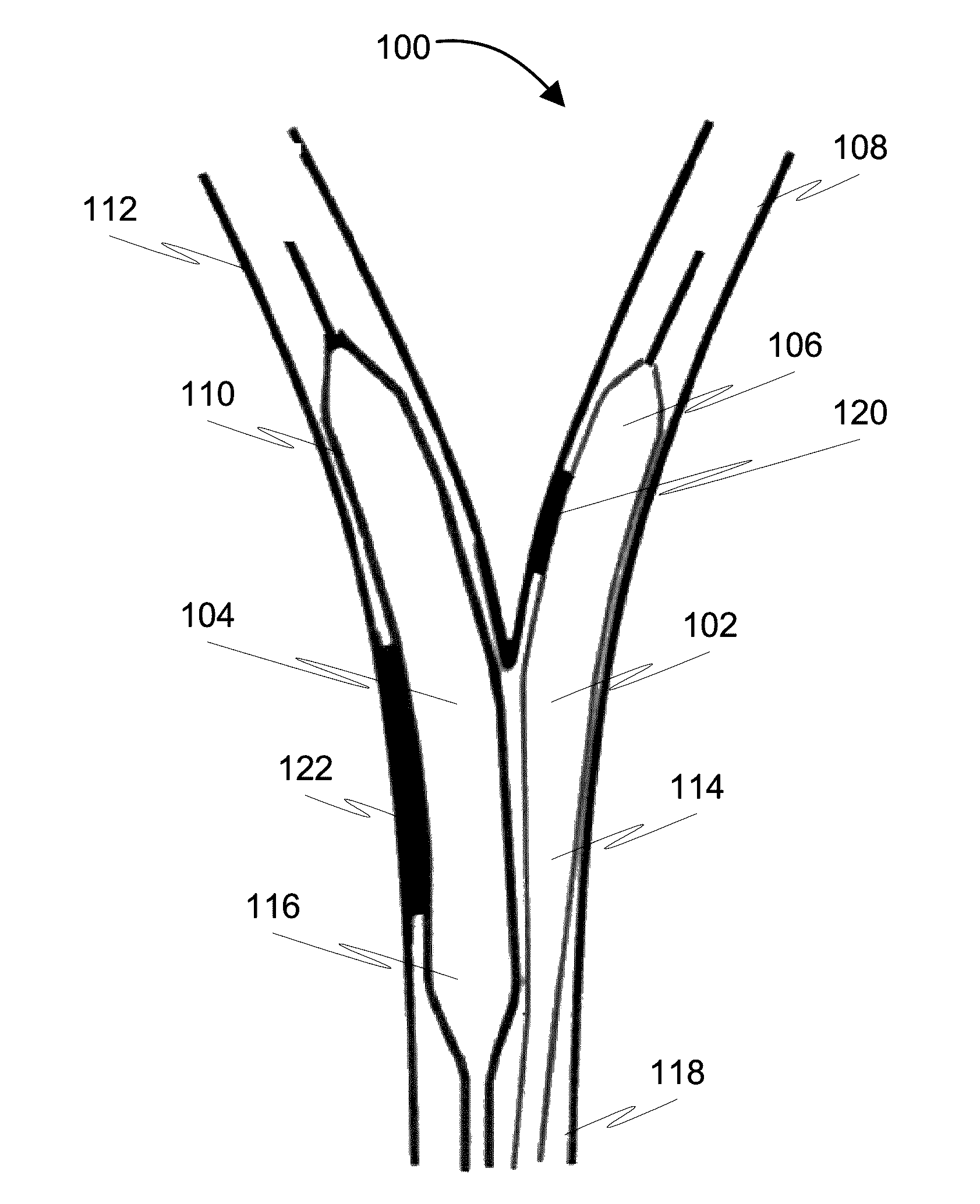 Method and a balloon catheter assembly for treating bifurcation lesions