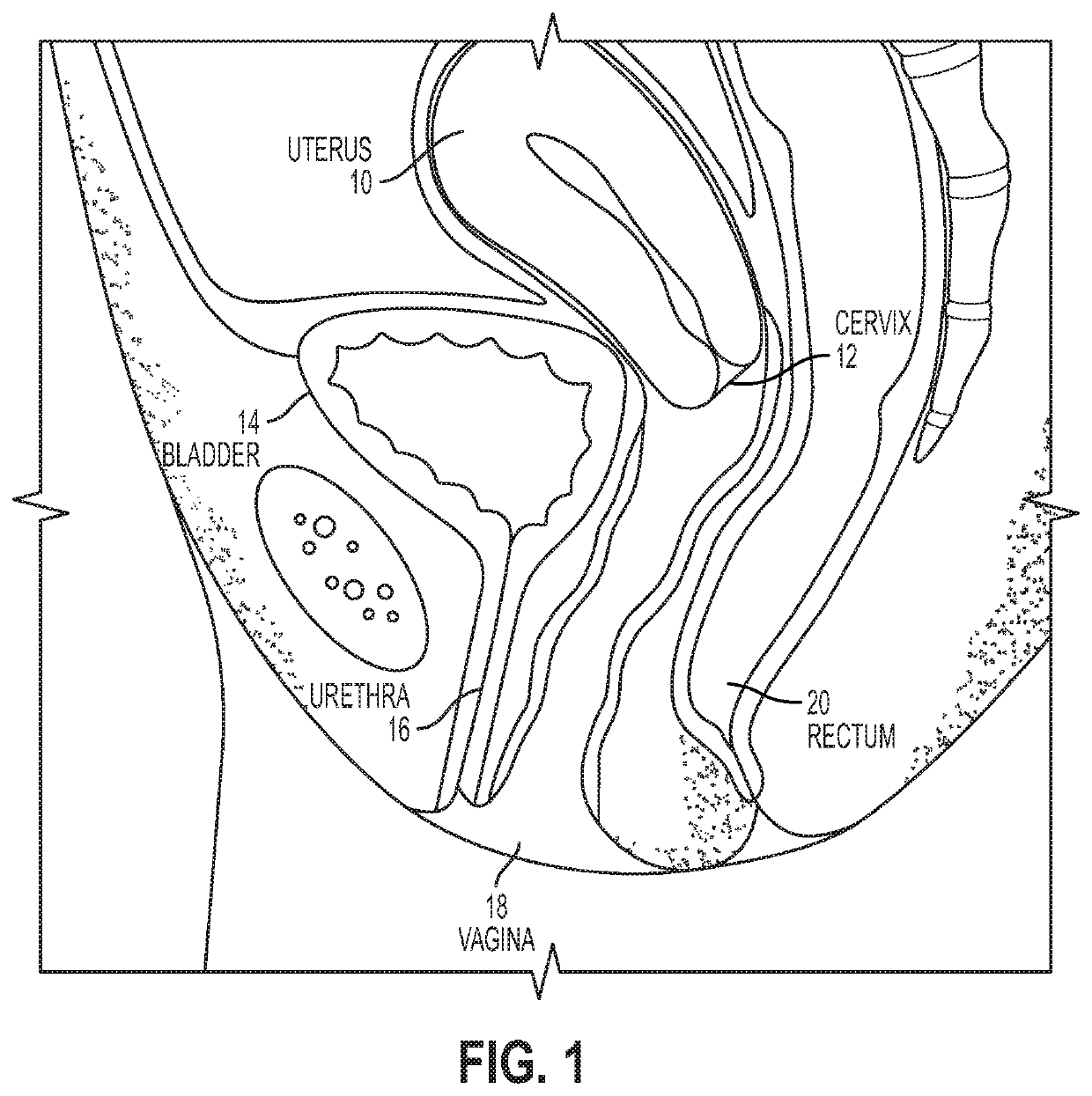 Intravaginal support devices and methods