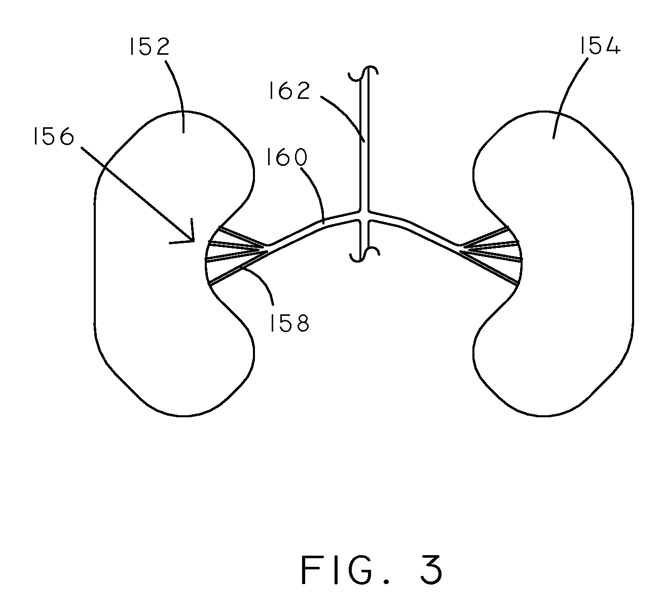 Osmotic Devices and Methods for Diuretic Therapy