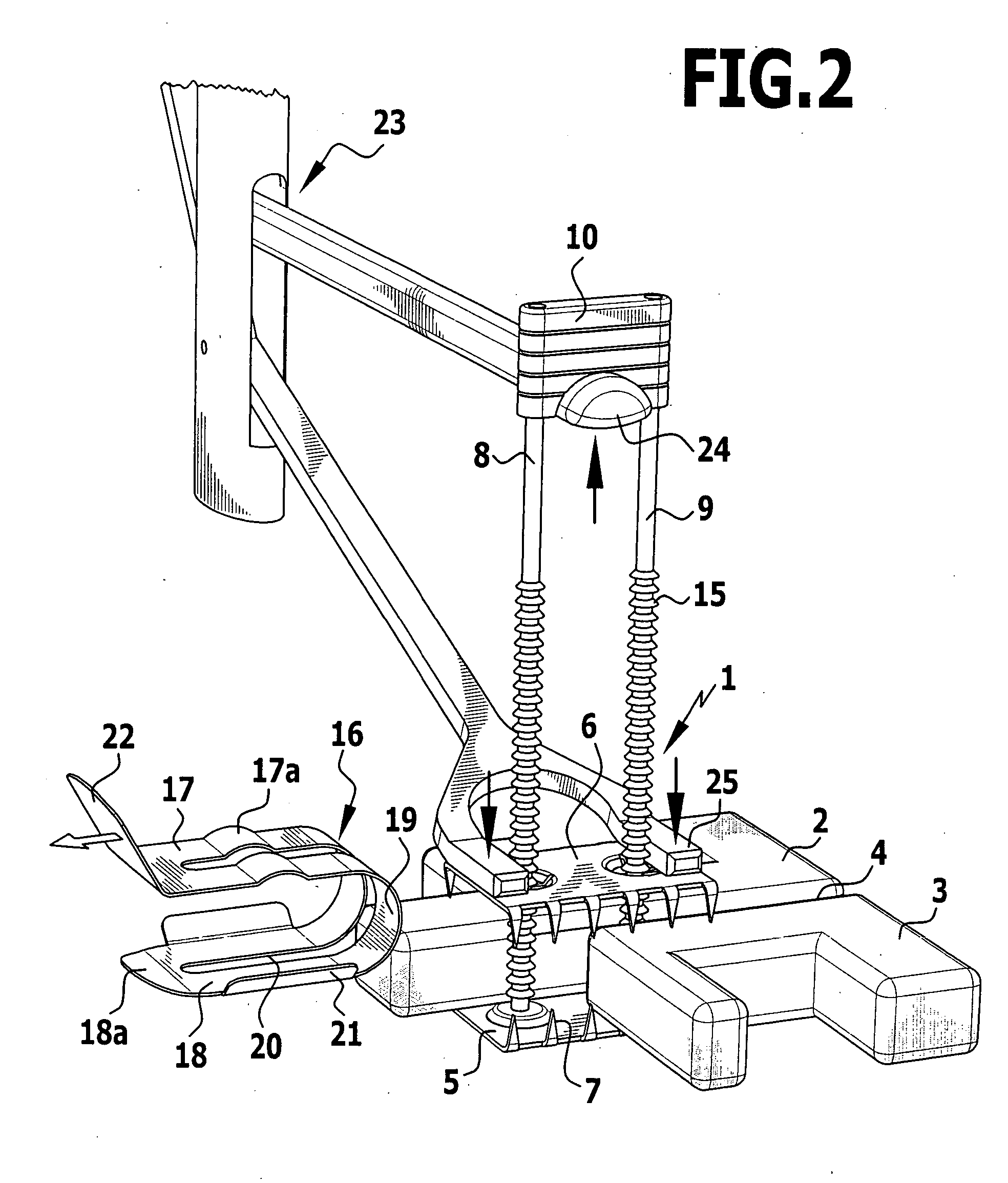 Surgical fixing device for two bone parts