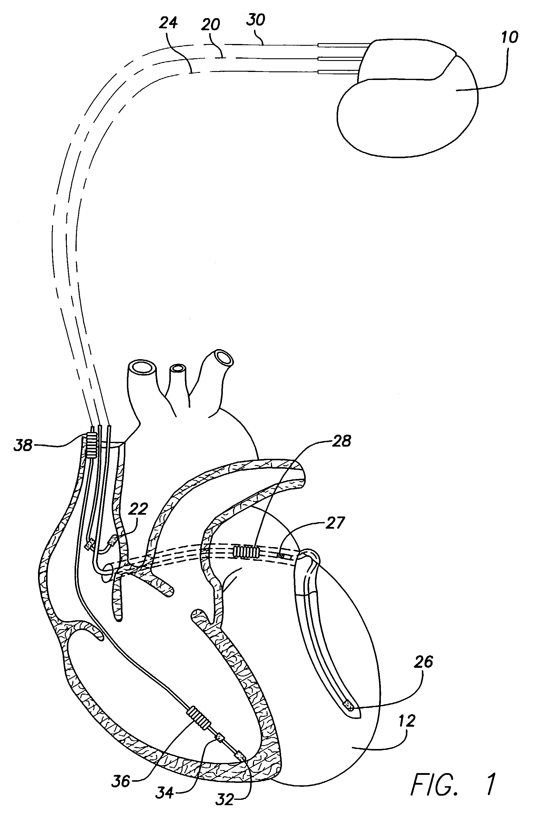 System and method for detecting circadian states using an implantable medical device