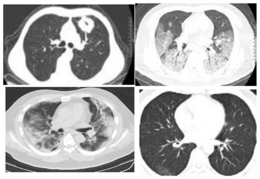 Lung CT image classification method based on feature migration