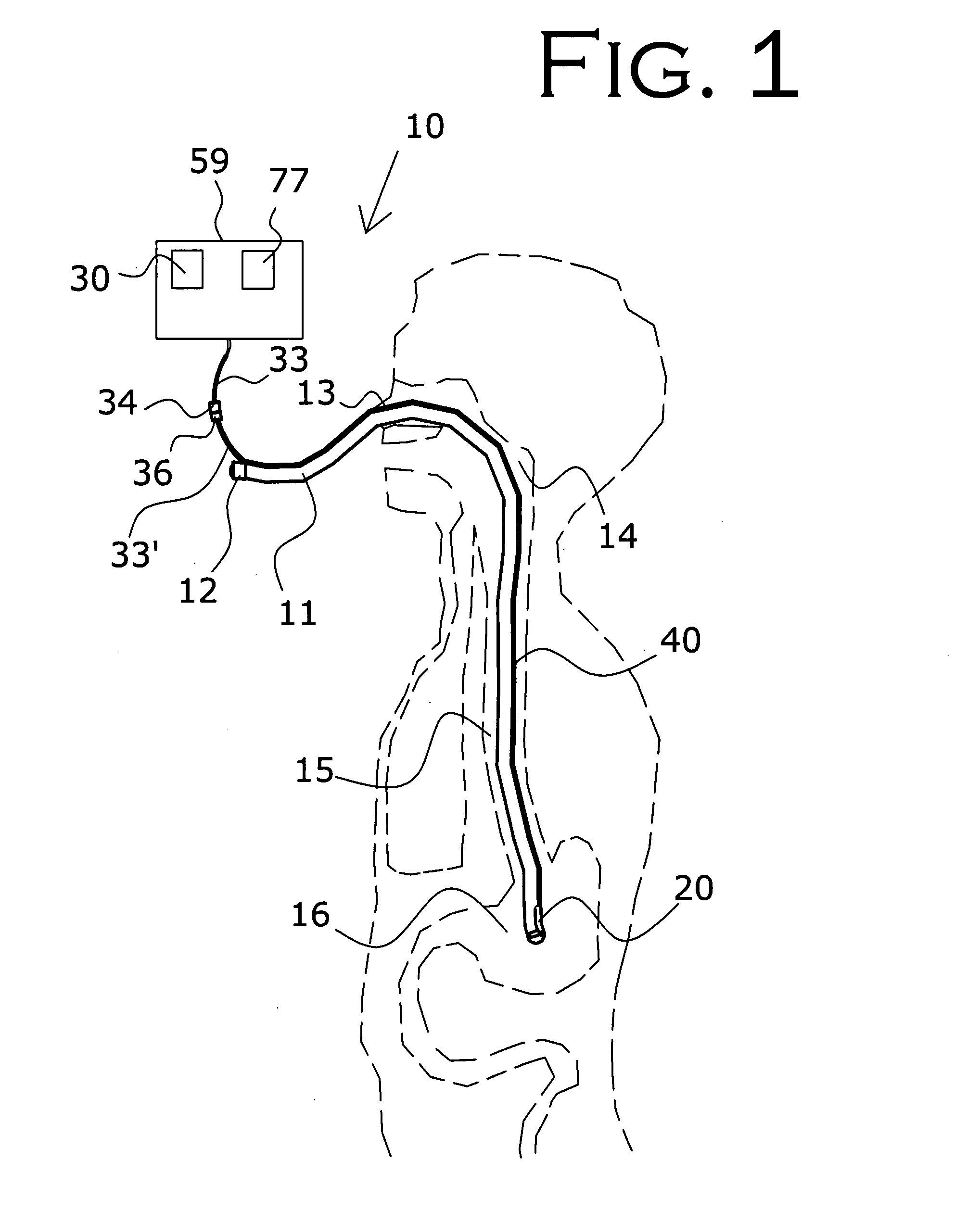 Nasogastric tube placement and monitoring system