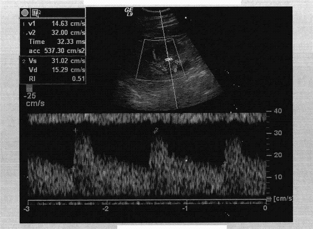 Ultrasonic image renal artery blood flow spectrum signal curve classification method