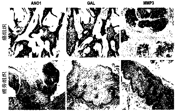 A biomarker for predicting prognosis in esophageal squamous cell carcinoma