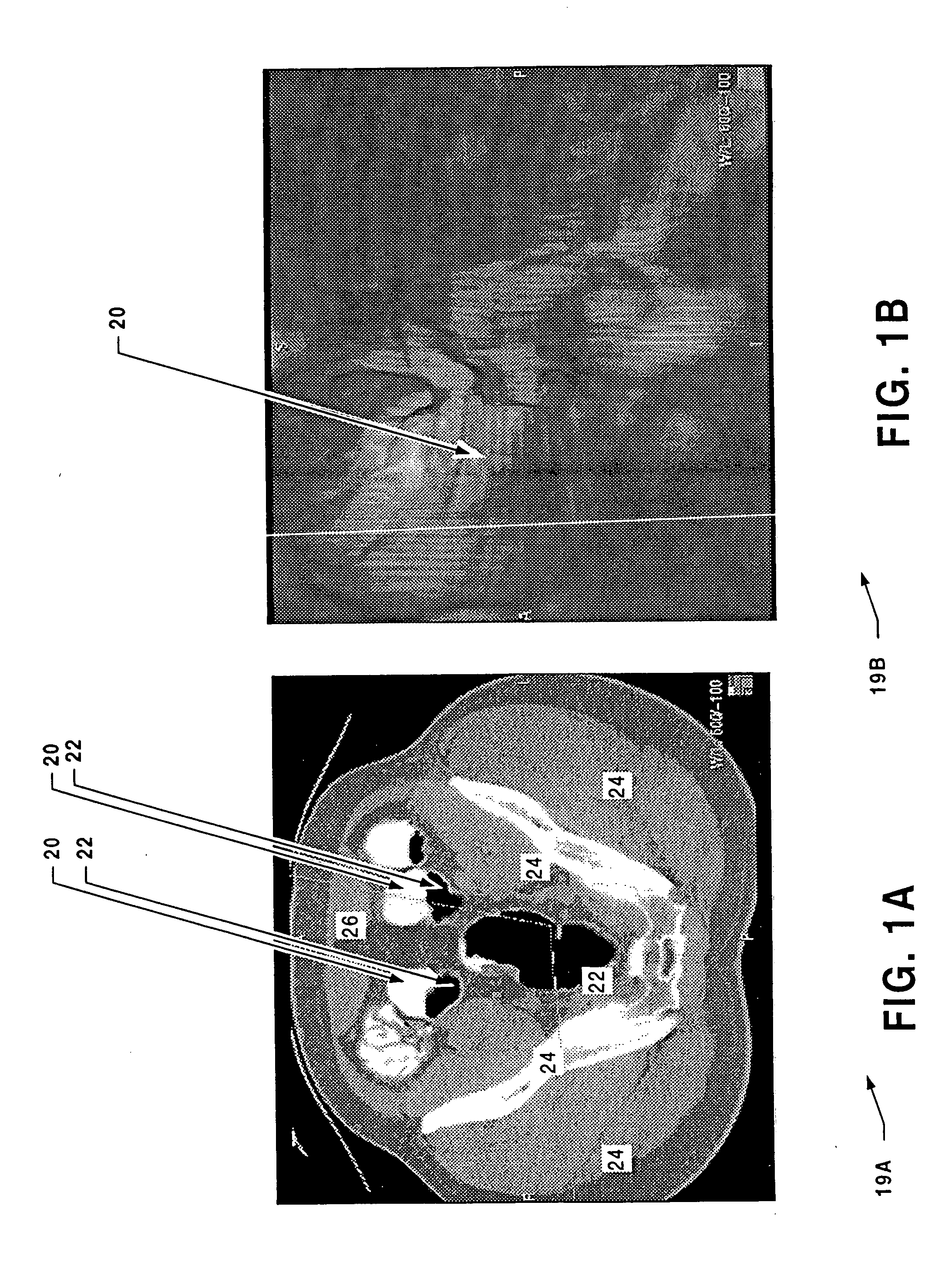Methods for digital bowel subtraction and polyp detection