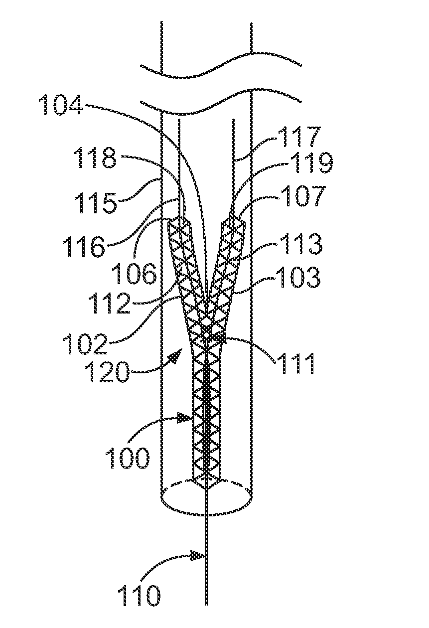 Vessel bifurcation stent deployment system with zippered catheters