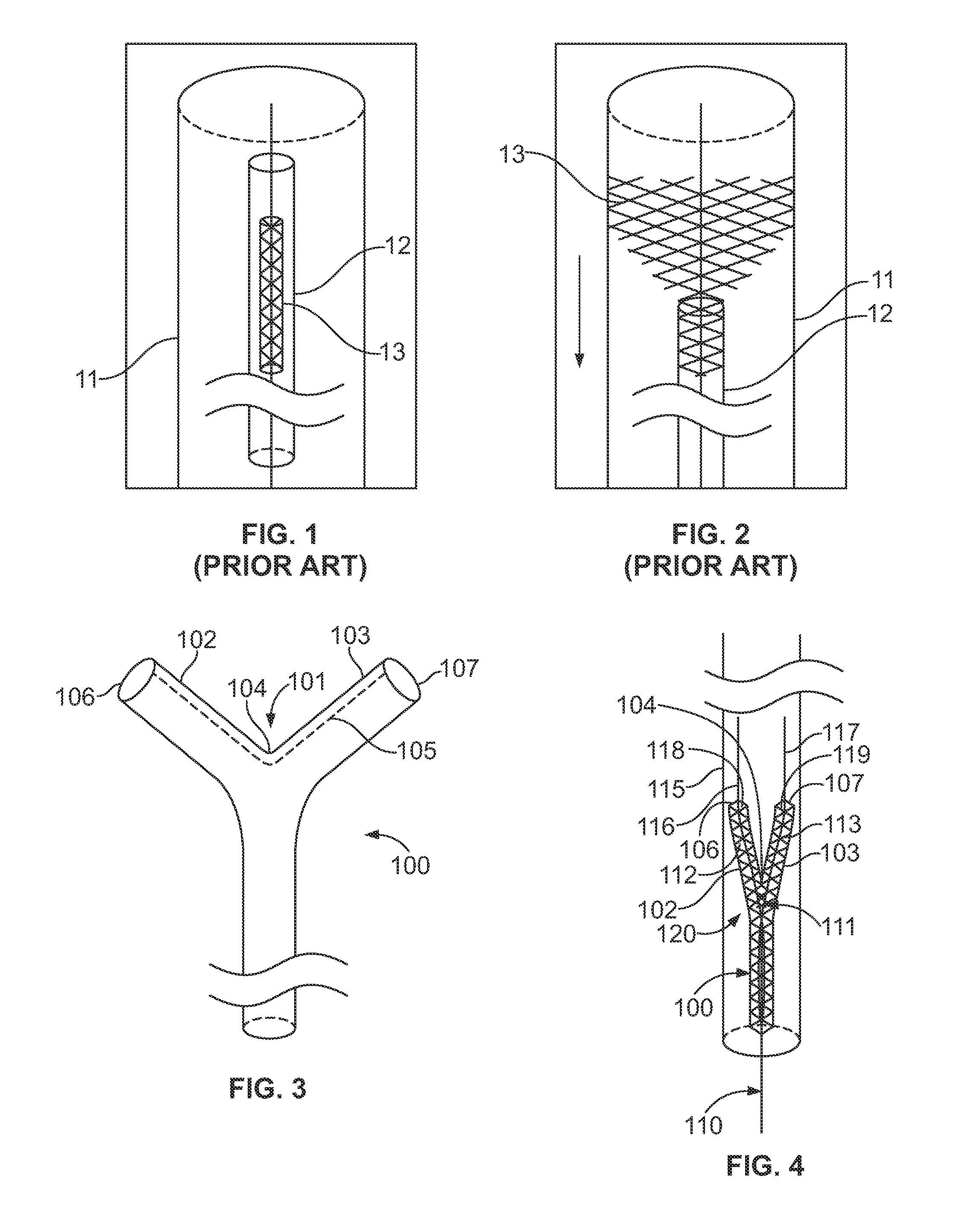 Vessel bifurcation stent deployment system with zippered catheters