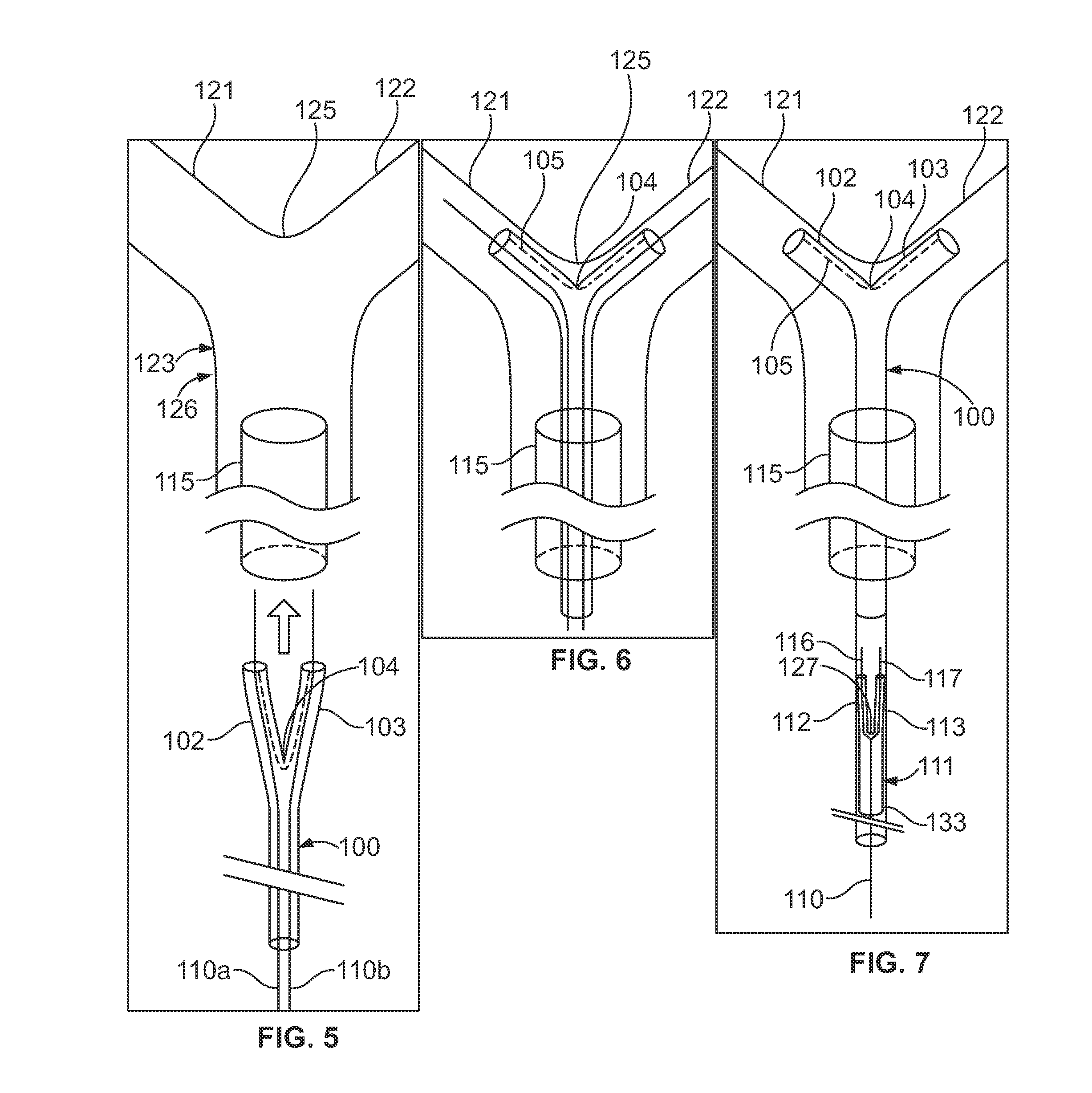 Vessel bifurcation stent deployment system with zippered catheters