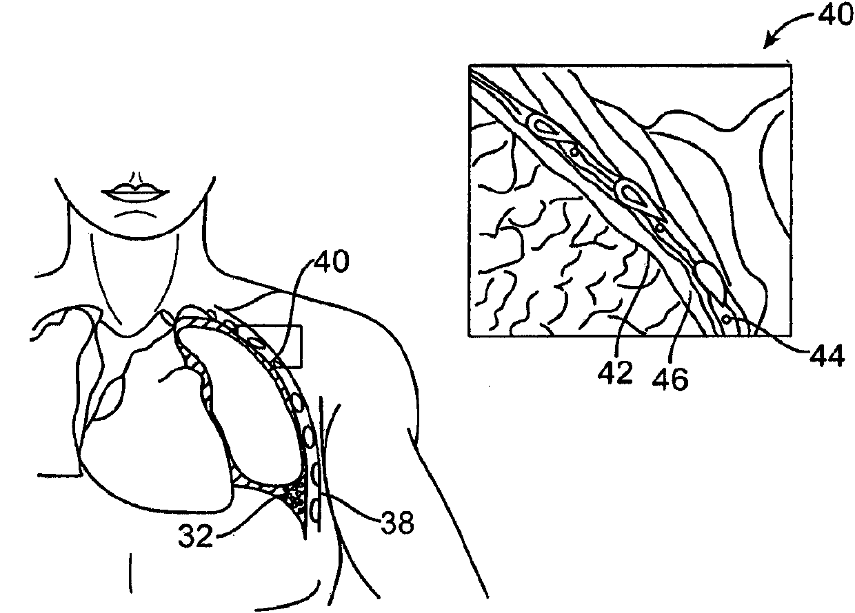 Cross-sectional modification during deployment of an elongate lung volume reduction device