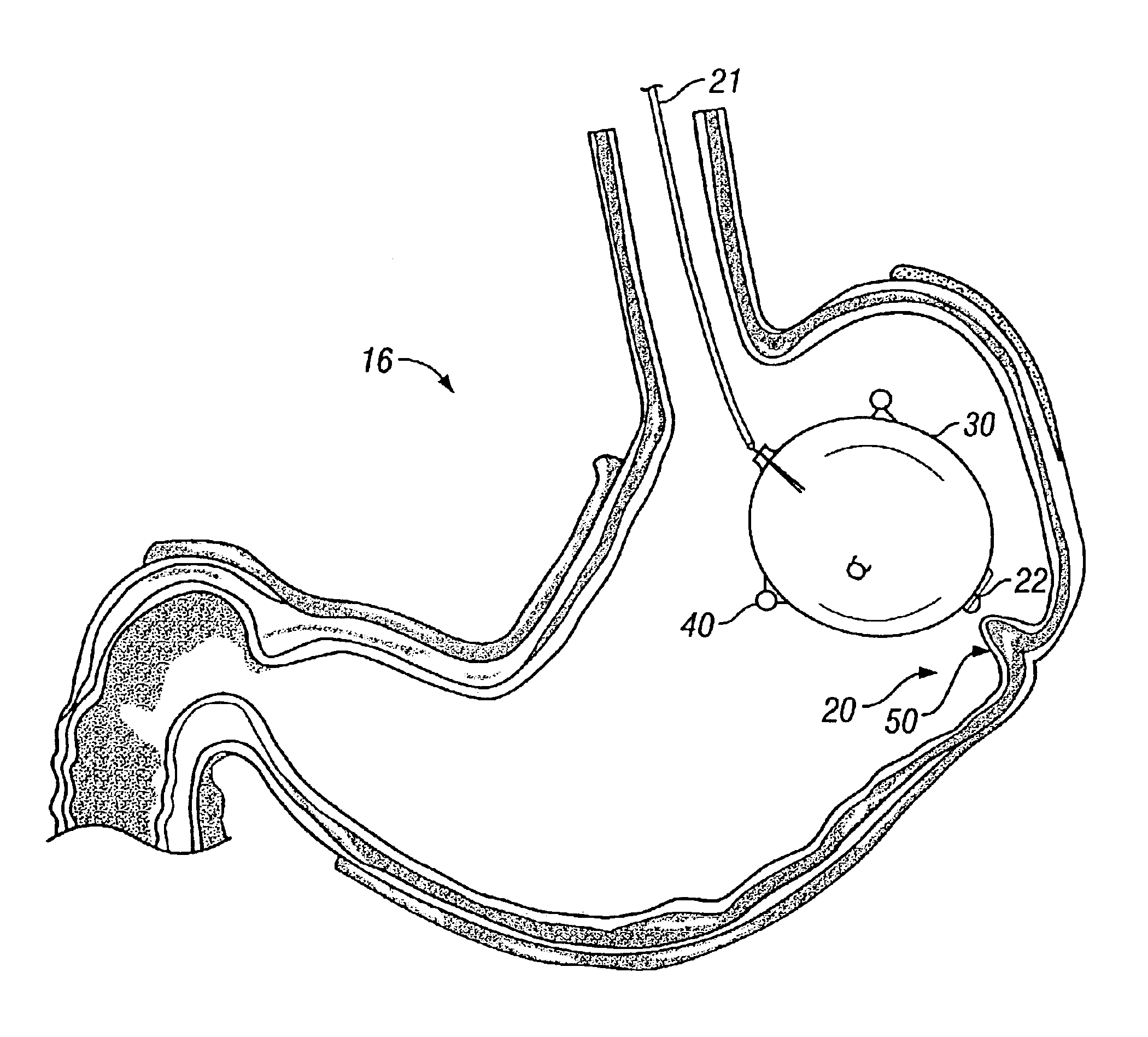 Intra-gastric fastening devices