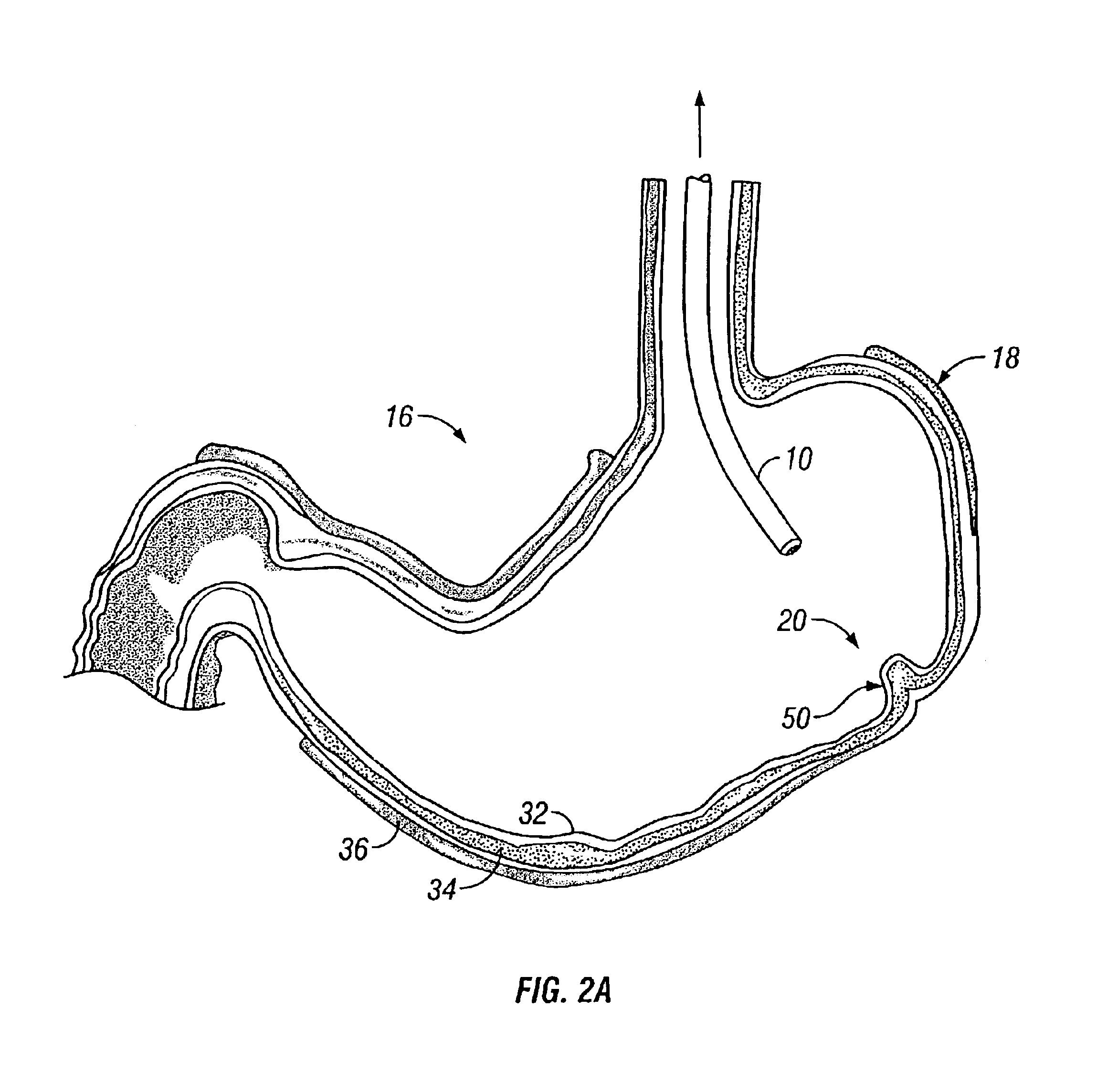 Intra-gastric fastening devices