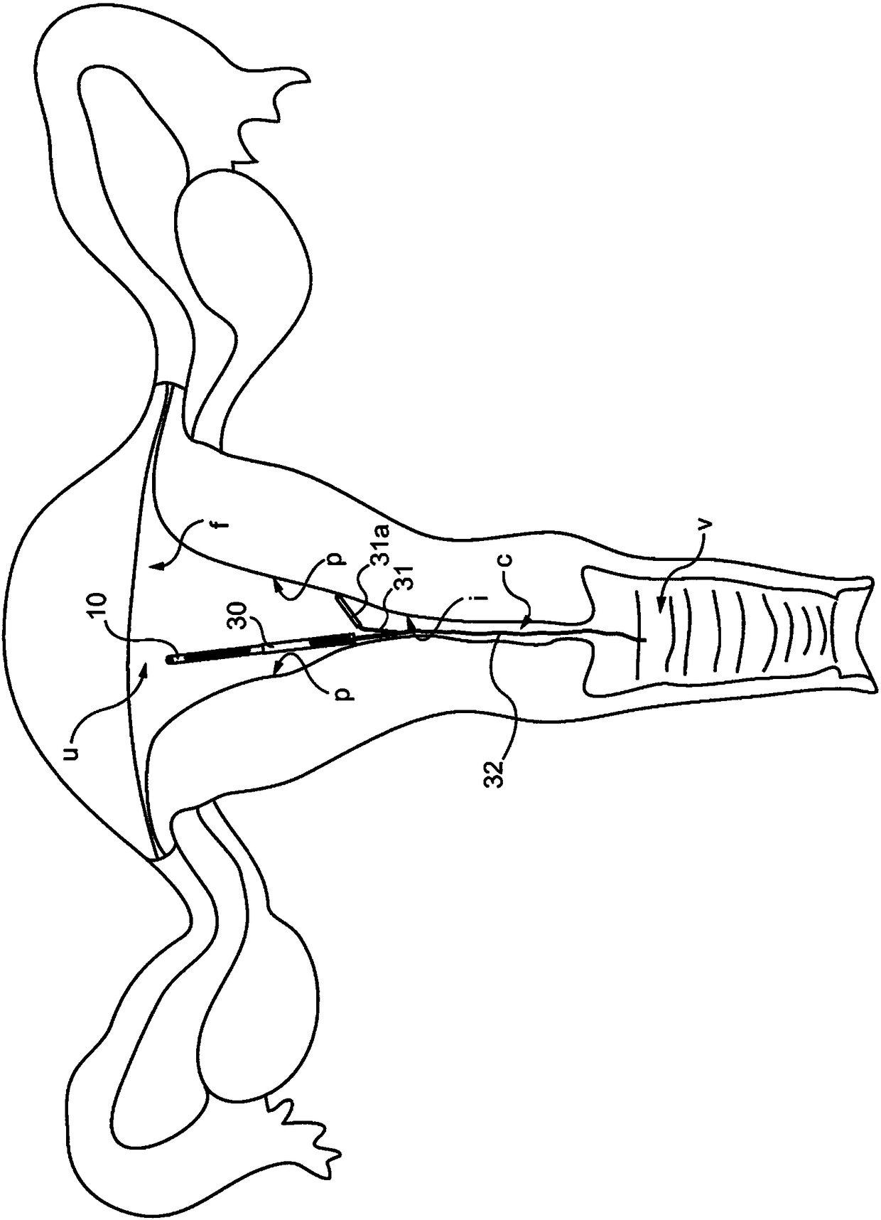 Retrievable intrauterine device