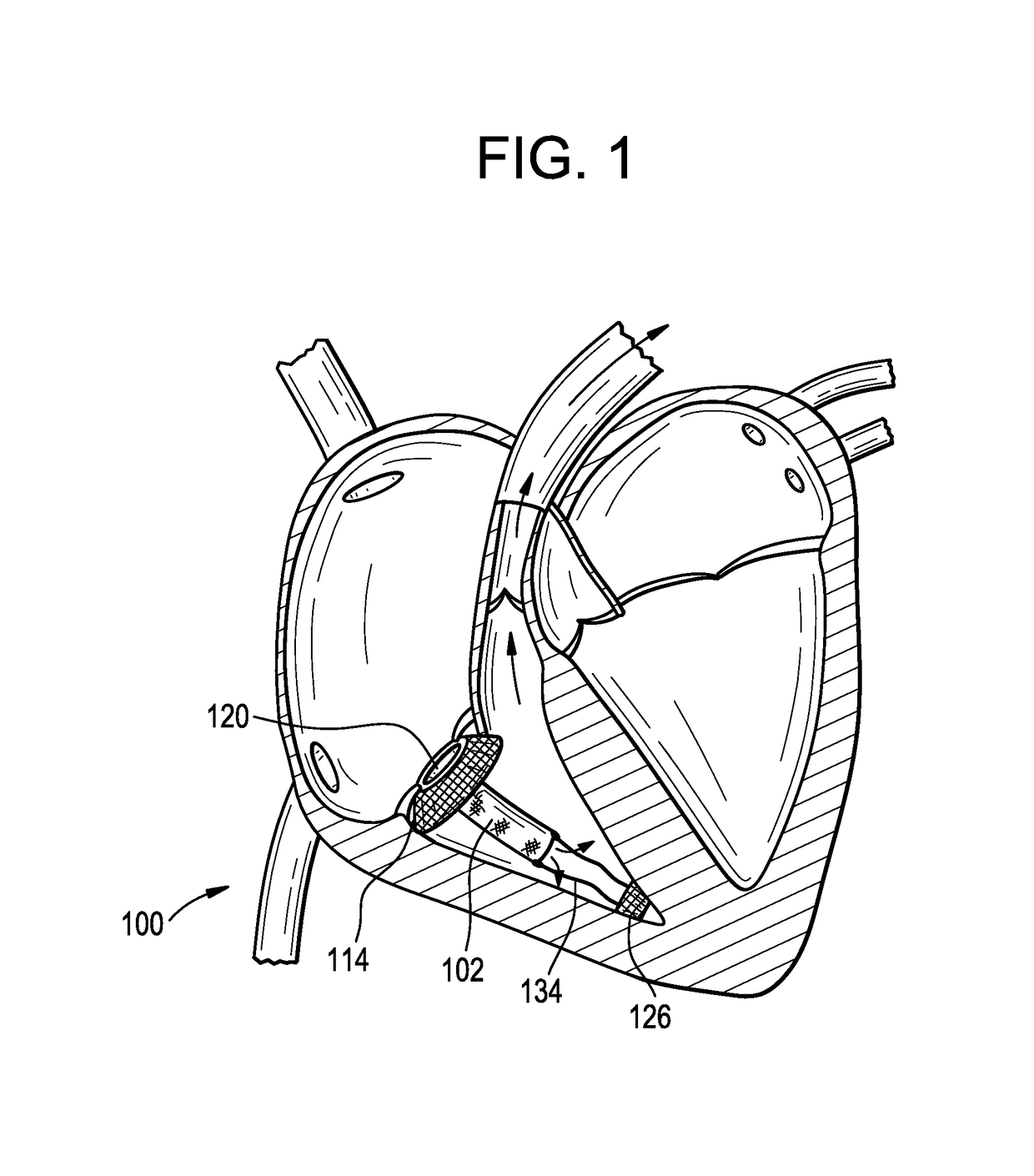 Pressure differential actuated prosthetic medical device