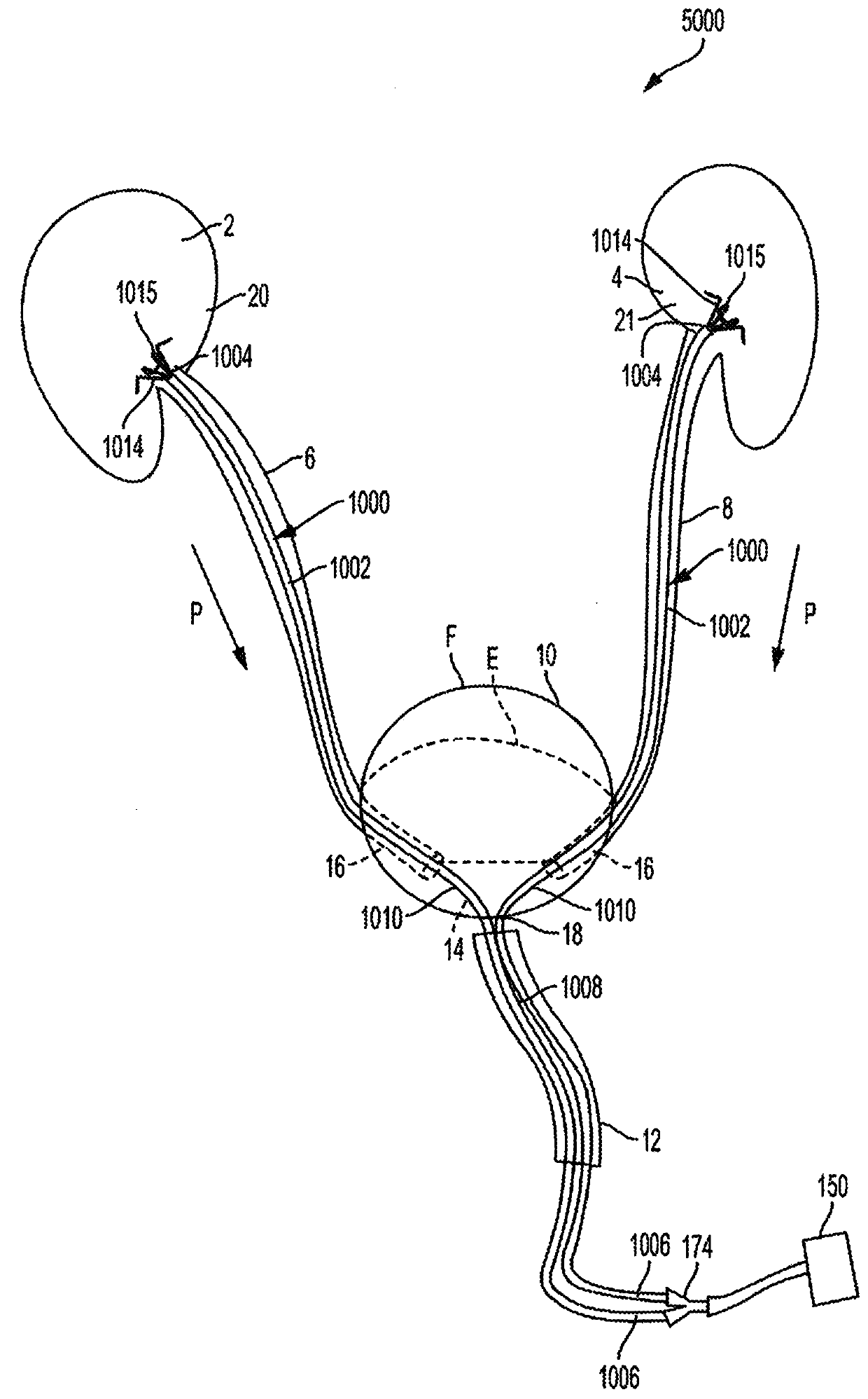 Ureteral and bladder catheters and methods of inducing negative pressure to increase renal perfusion