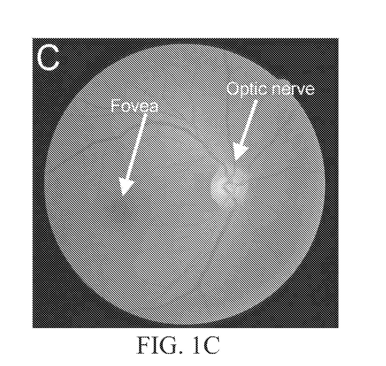 Self-illuminated handheld lens for retinal examination and photography and related method thereof