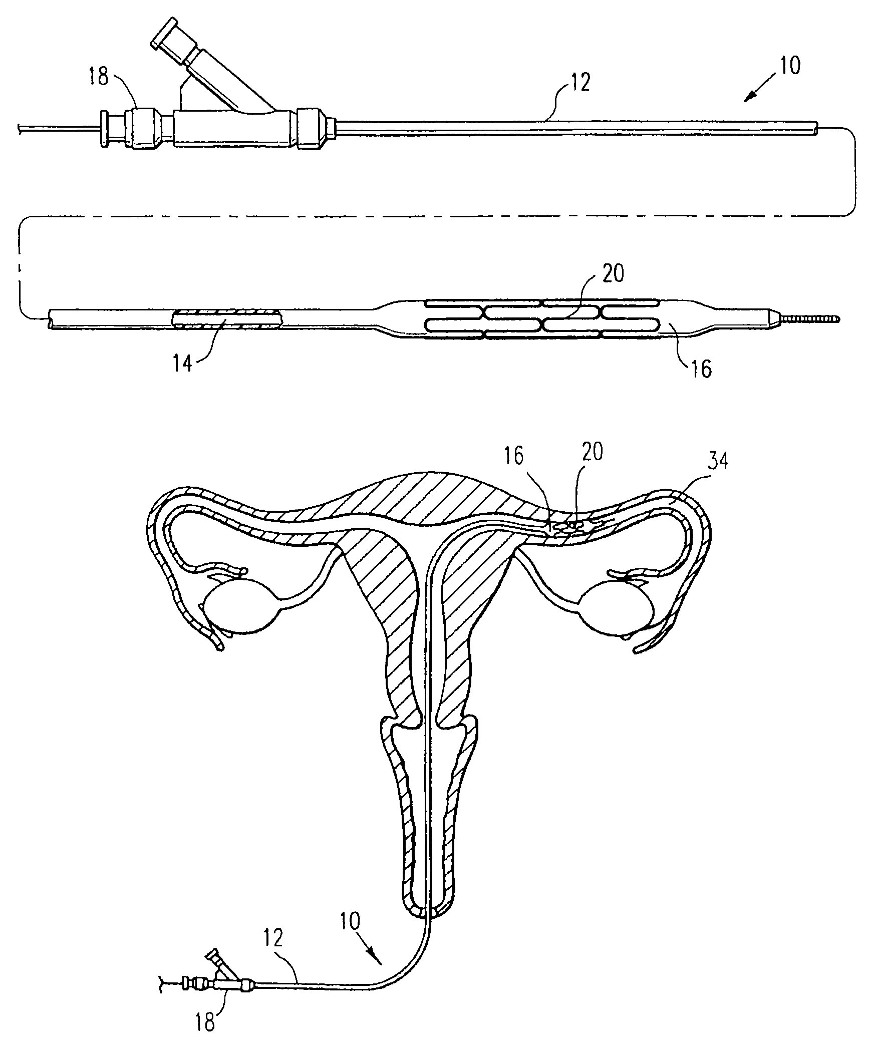 Contraceptive system and method of use