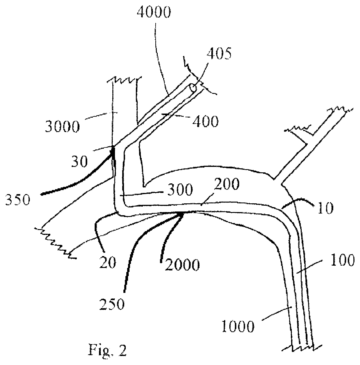 Segmented arch fulcrum support catheter and method of use