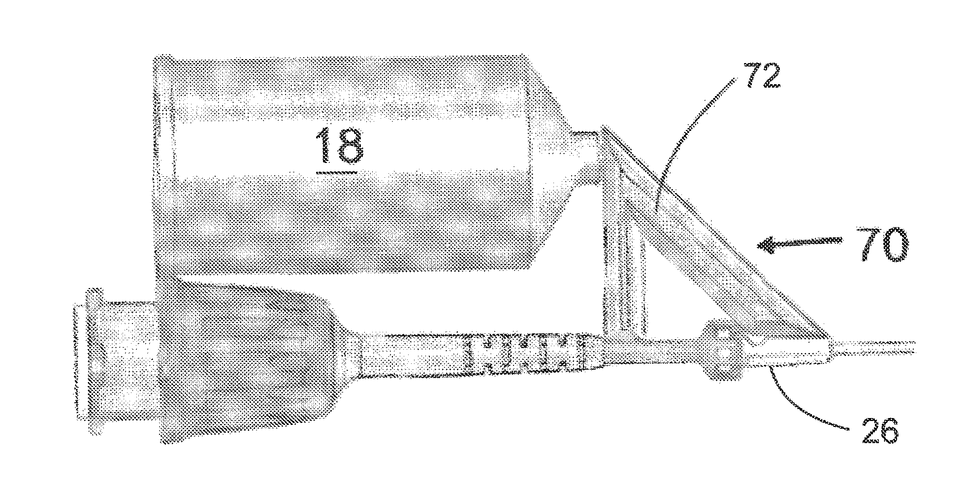 Automated Fluid Delivery Catheter and System