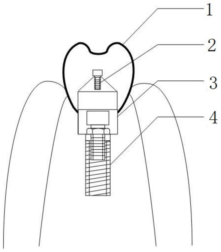 Dental implant repair screw looseness monitoring system and method