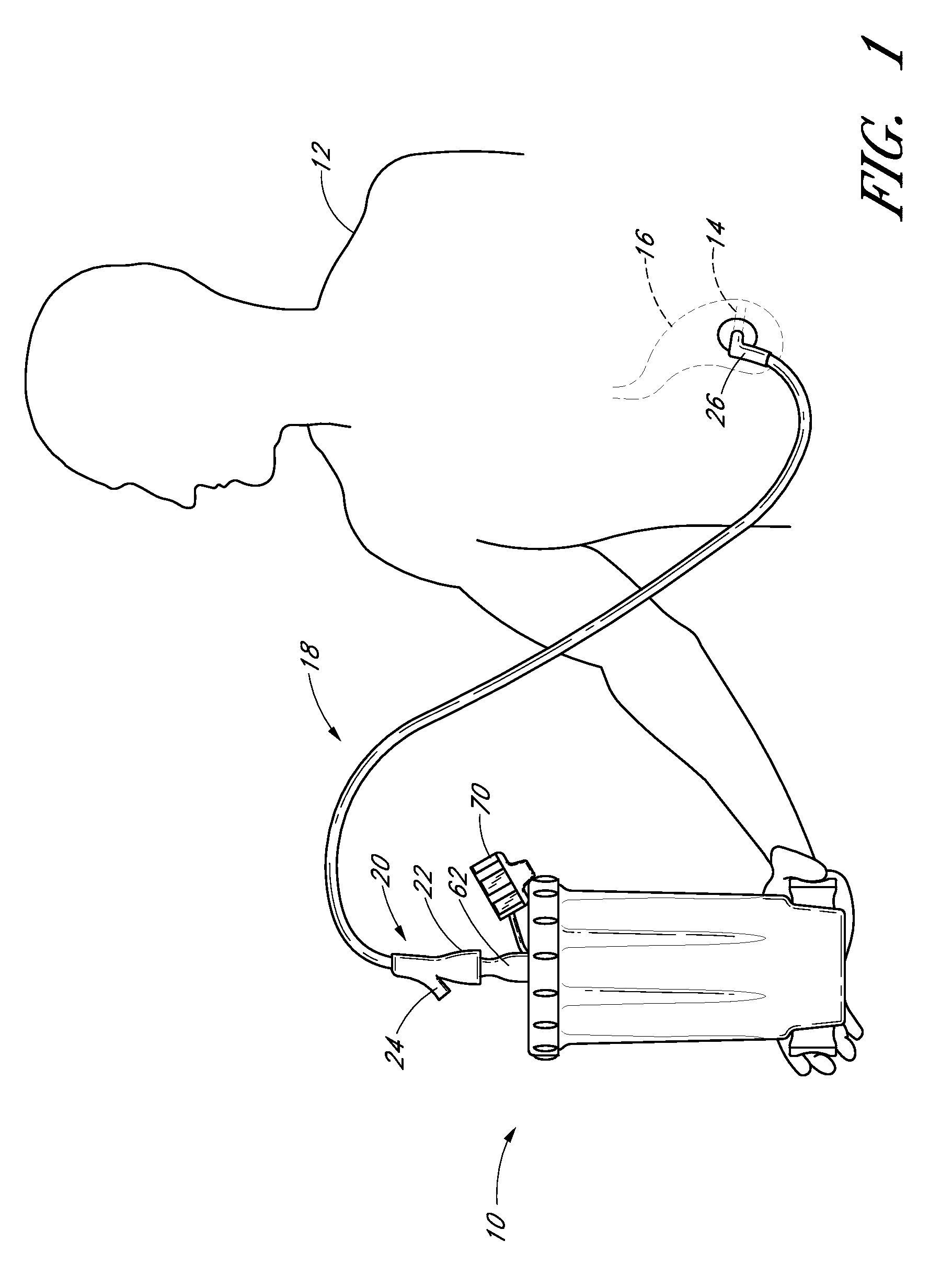 Enteral feeding systems, devices and methods