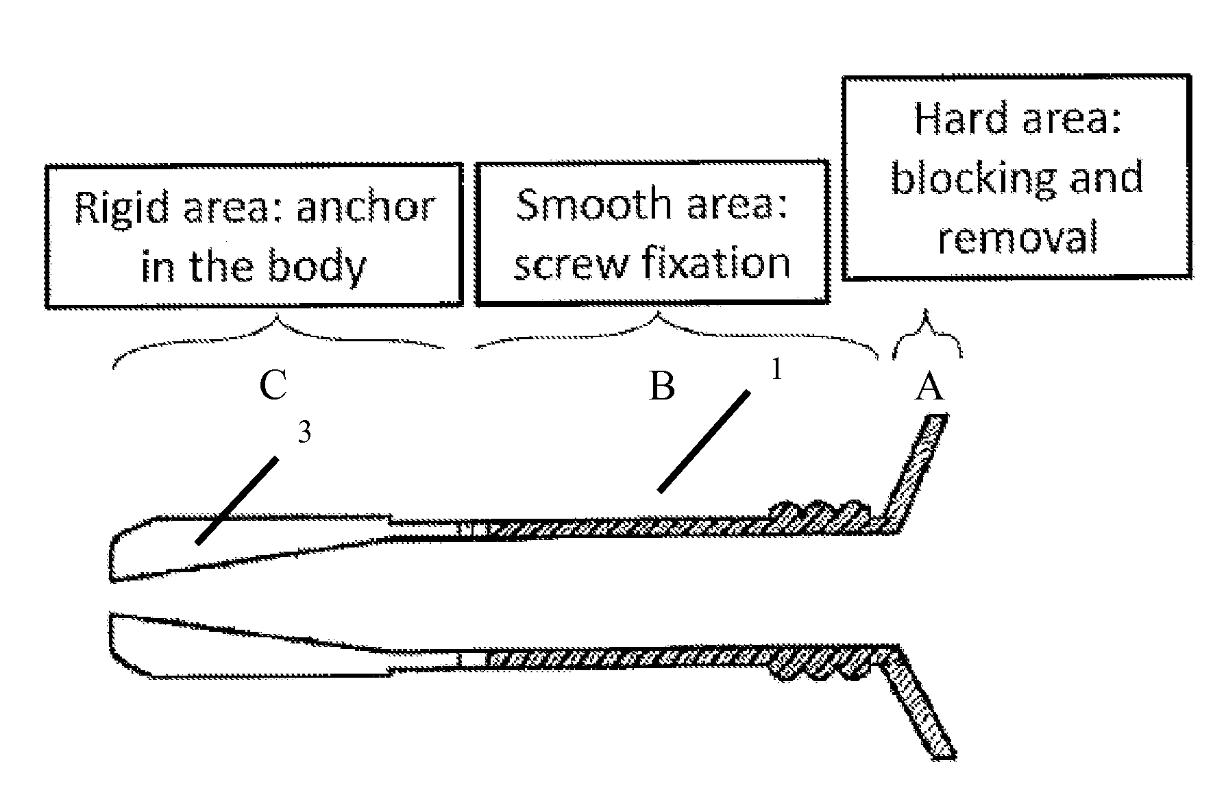 Universal anchor for bone fixation