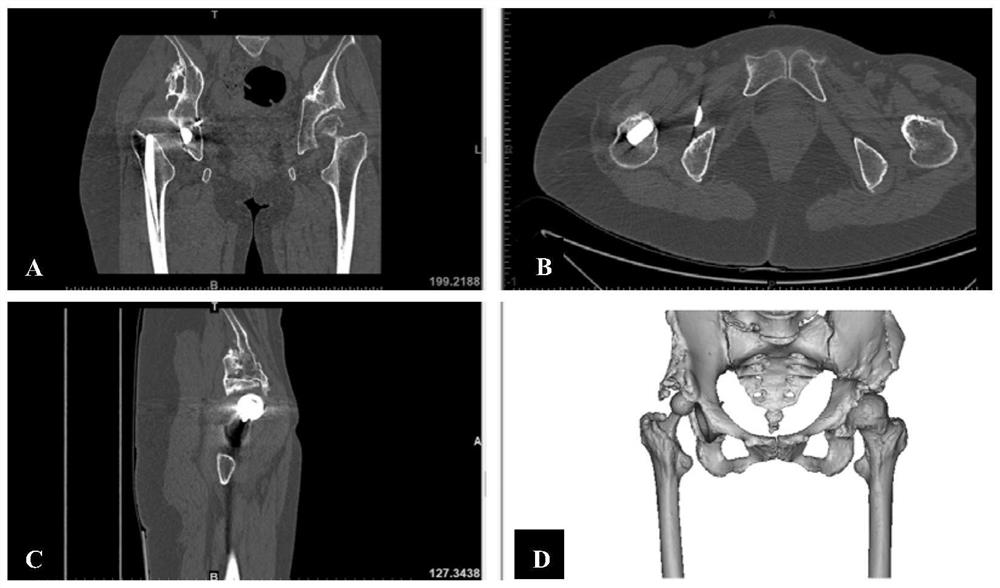 Preoperative planning method for hip joint revision surgery