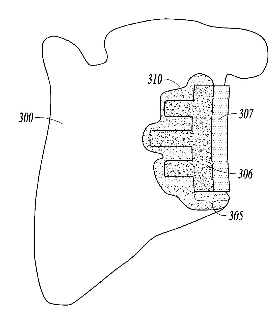 Curable calcium phosphate compositions for use with porous structures and methods of using the same