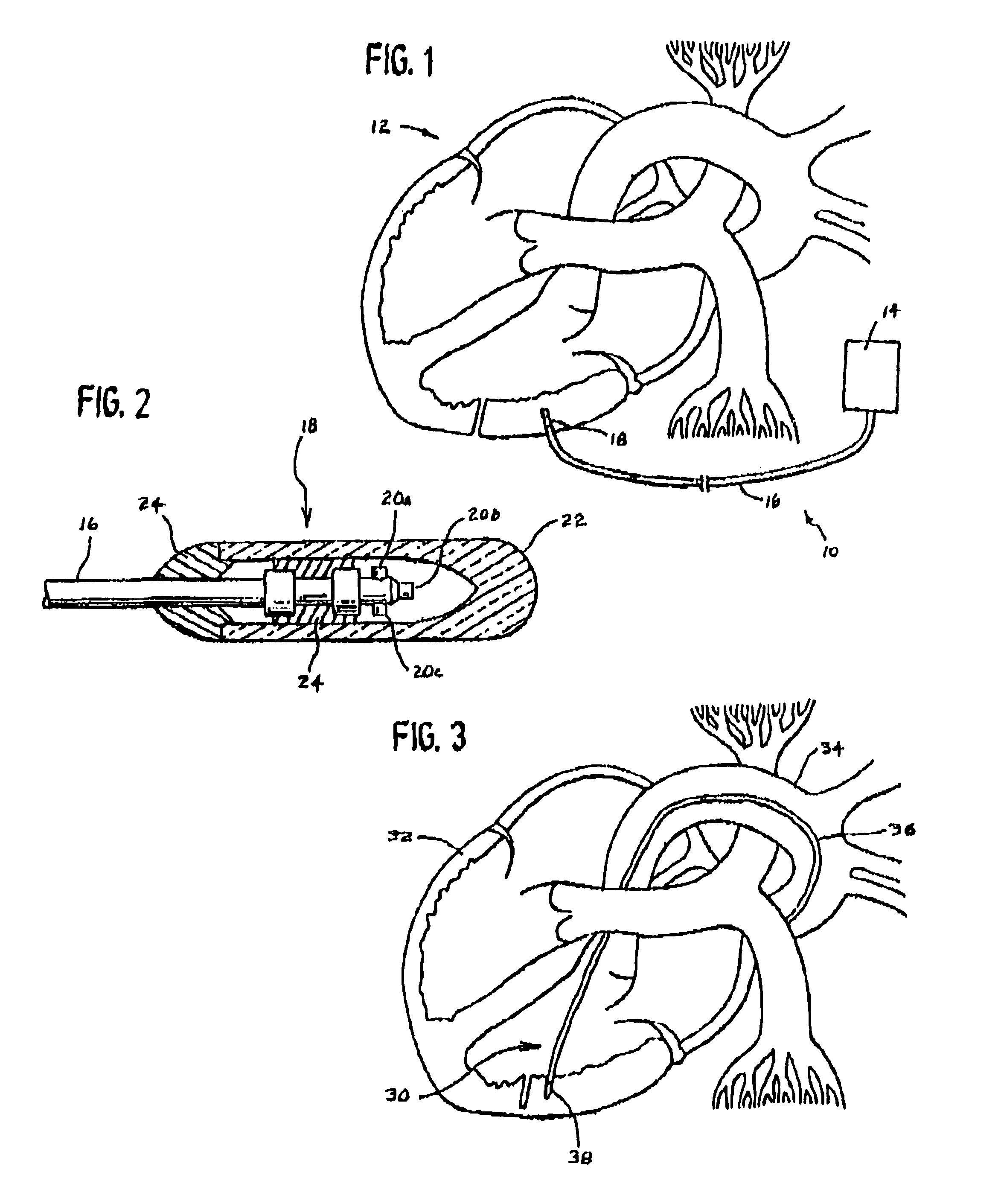 Method and apparatus for increasing angiogenic, growth factor in heart muscle