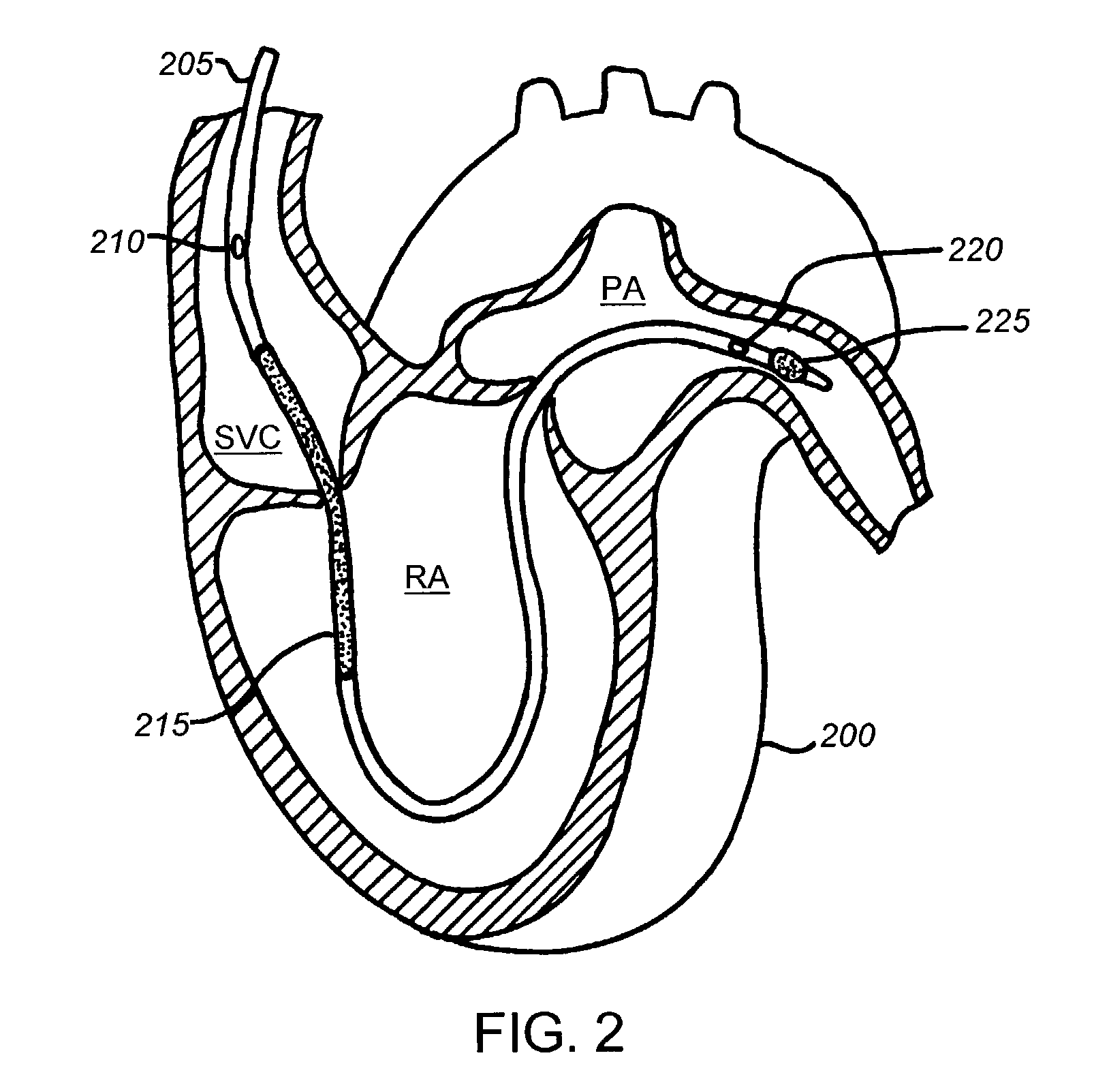 System and method for noise reduction in thermodilution for cardiac measurement