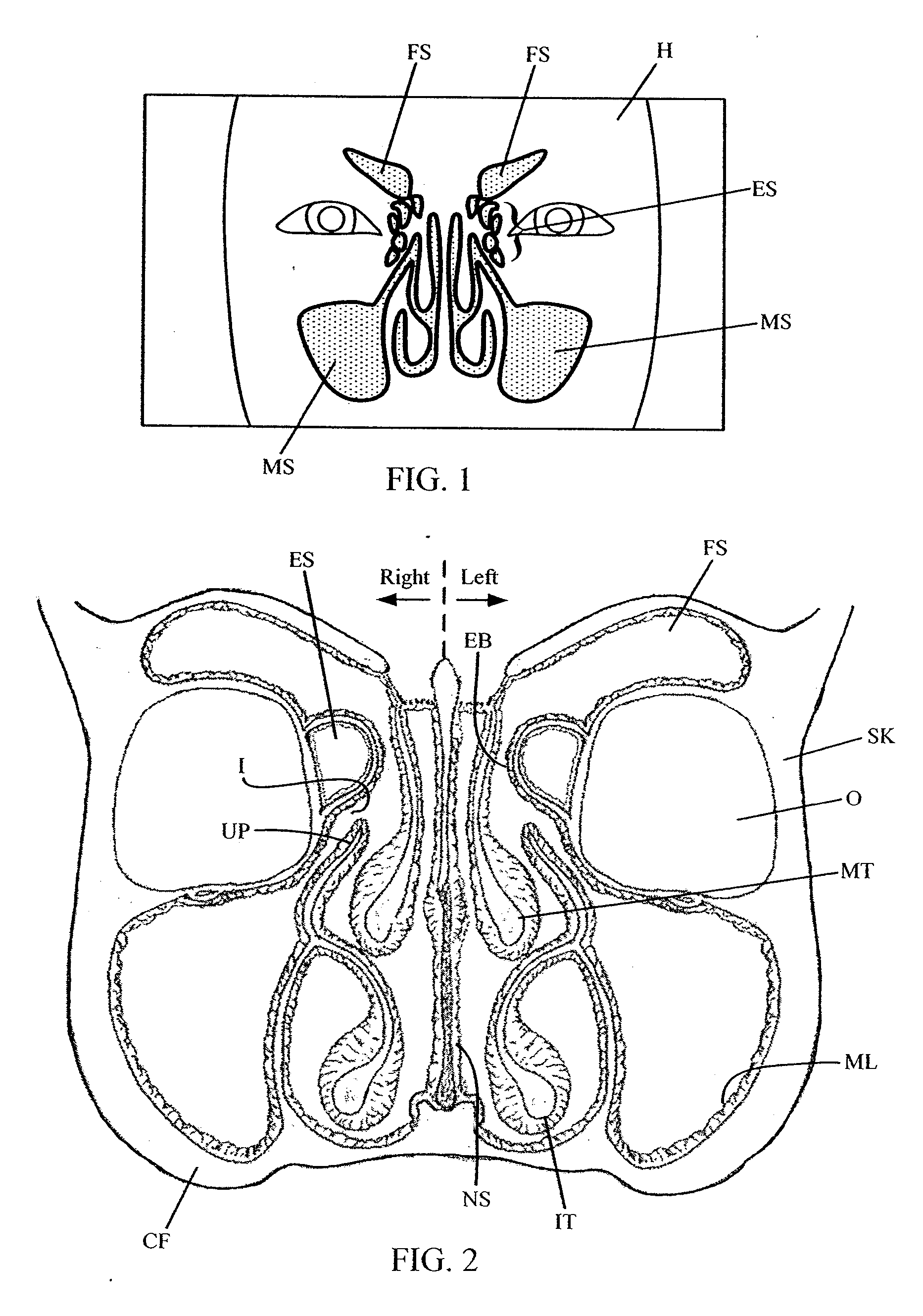 Method for accessing a sinus cavity and related anatomical features