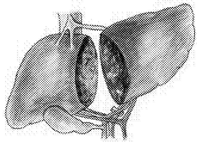 Total Laparoscopic Two-Stage Surgical Method for Resection of Side of Liver of Patient via Liver-Surrounding Band Method