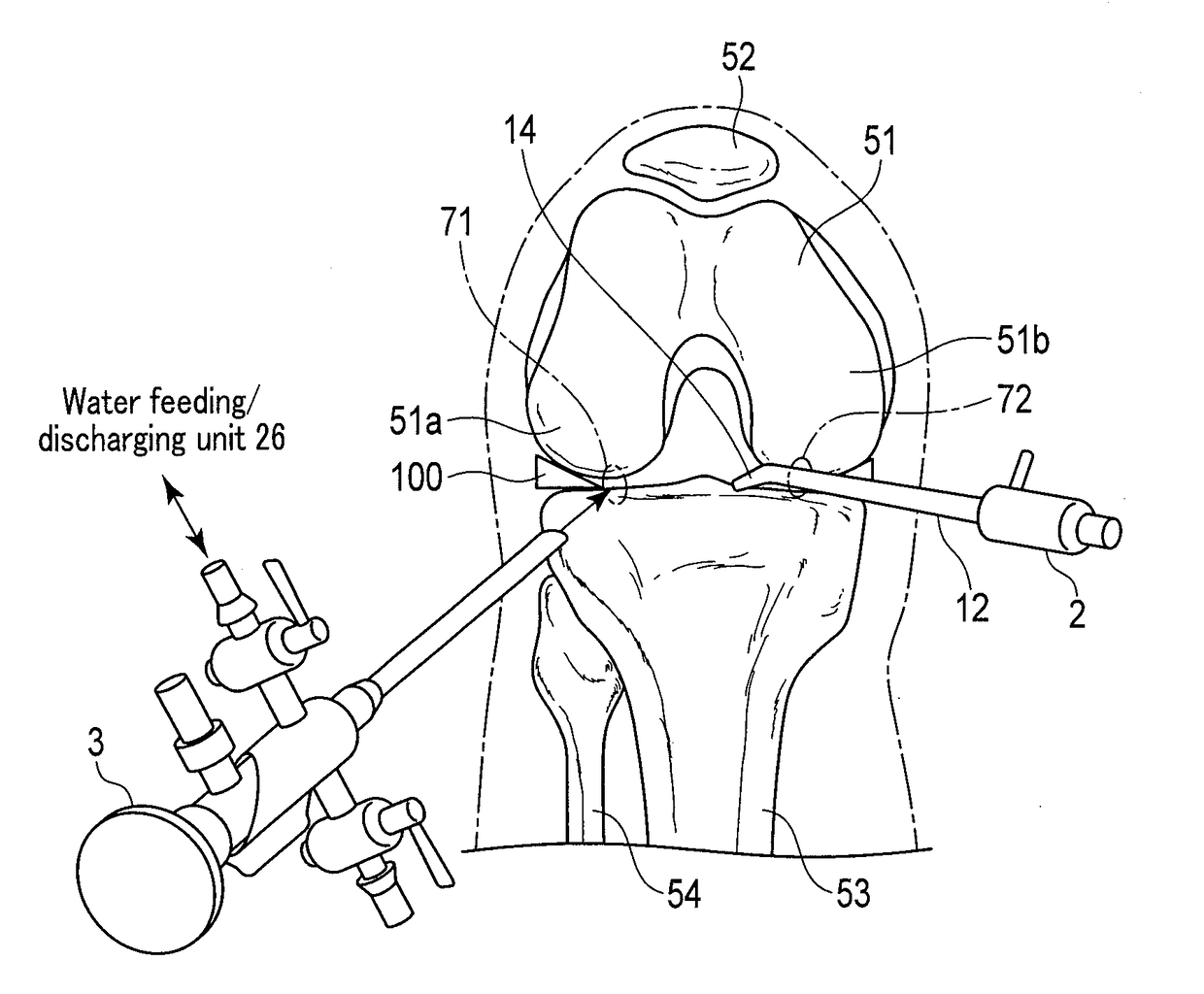 Meniscectomy by arthroendoscopical surgical method