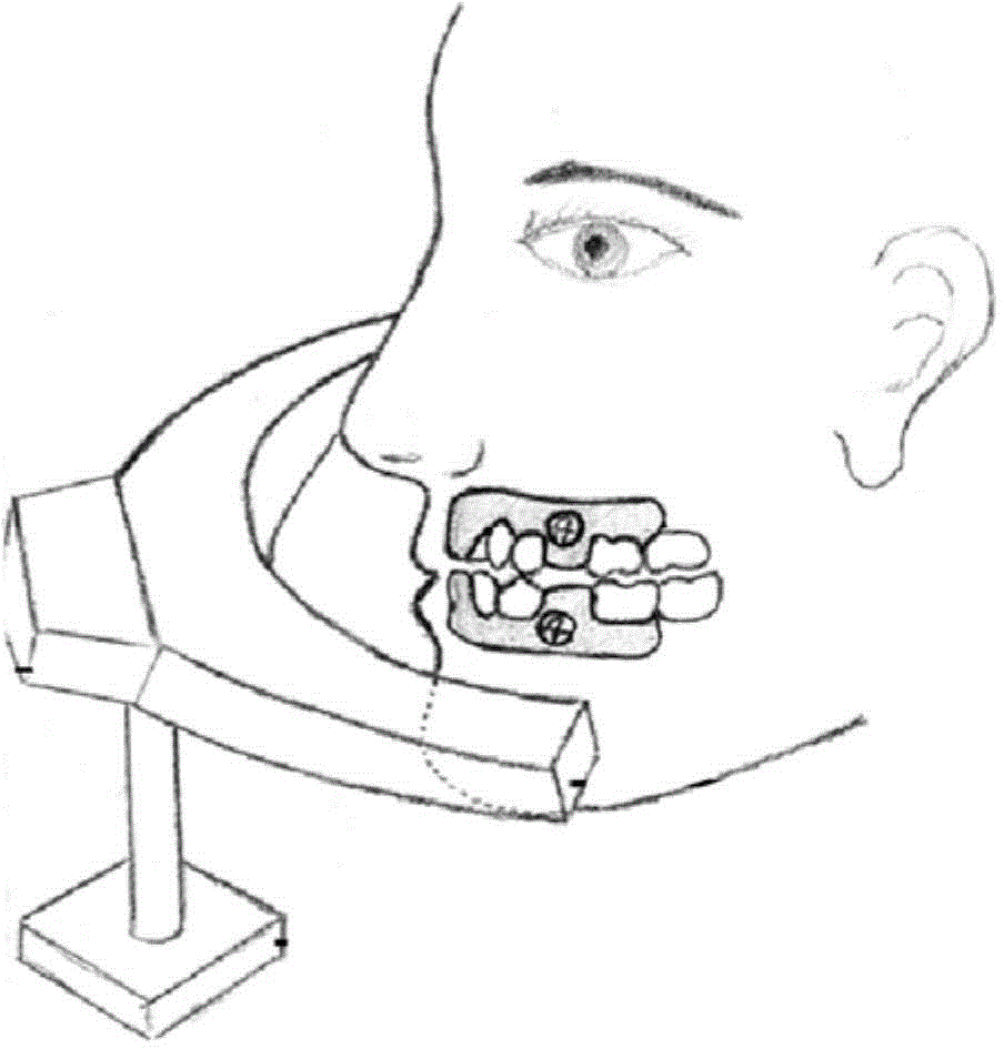 Wireless orthodontic auxiliary treatment apparatus
