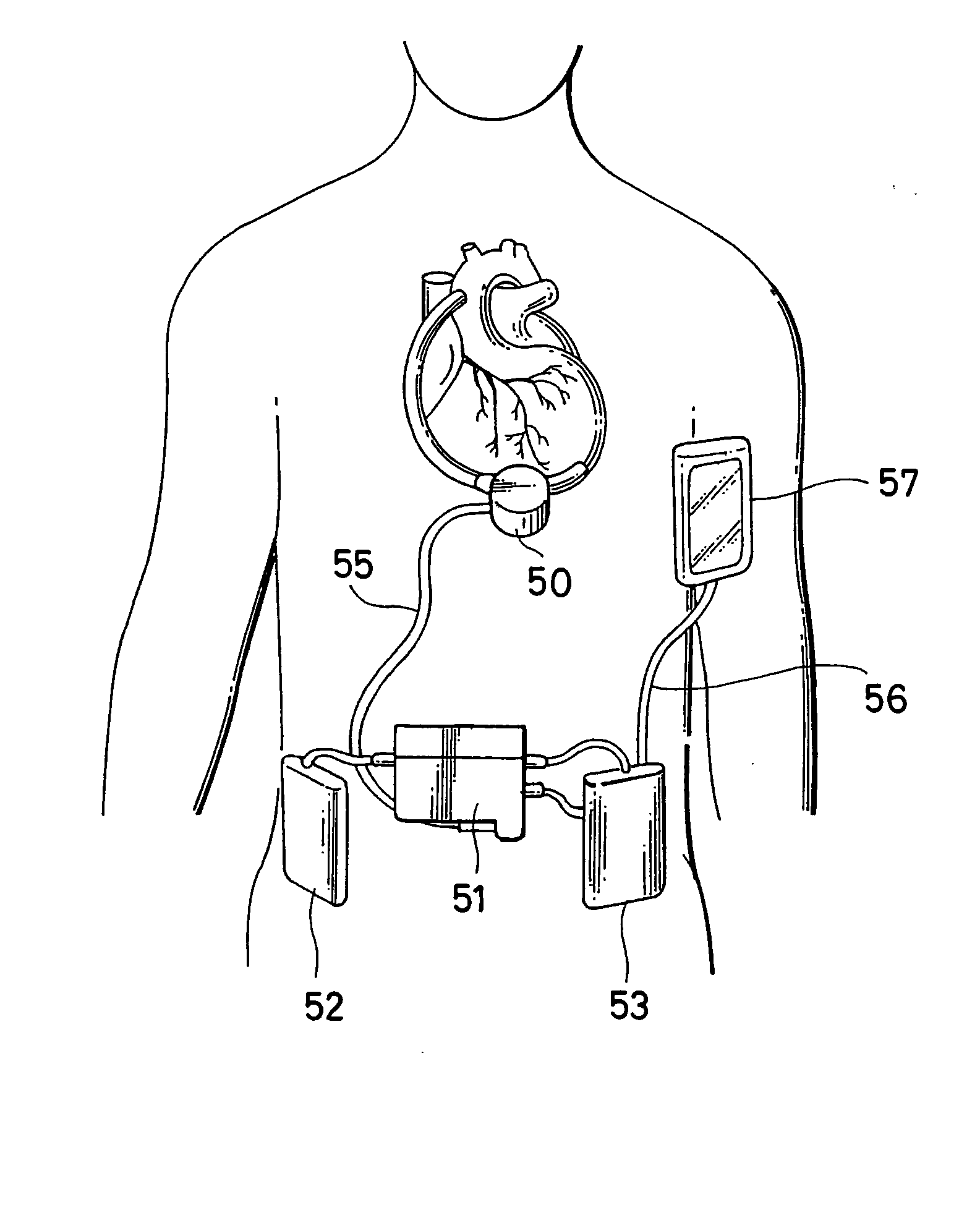Artificial heart pump system and its control apparatus