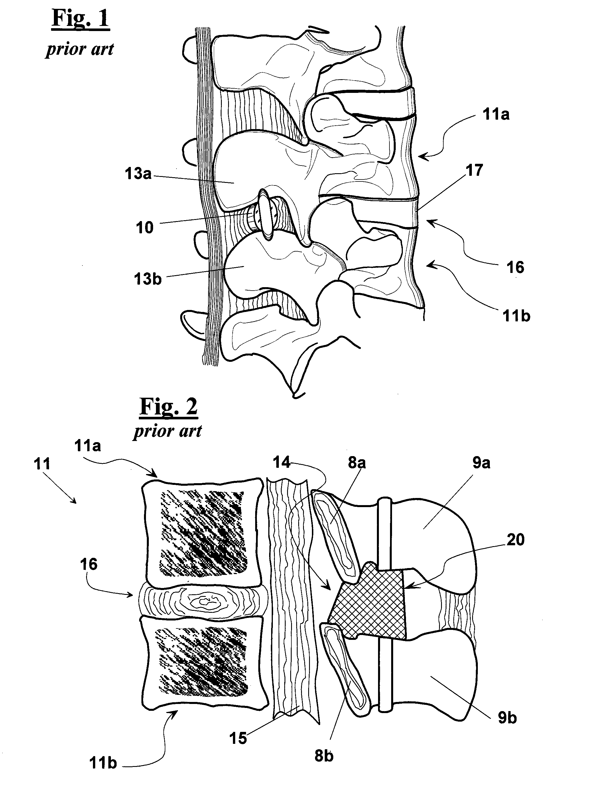 Intervertebral support