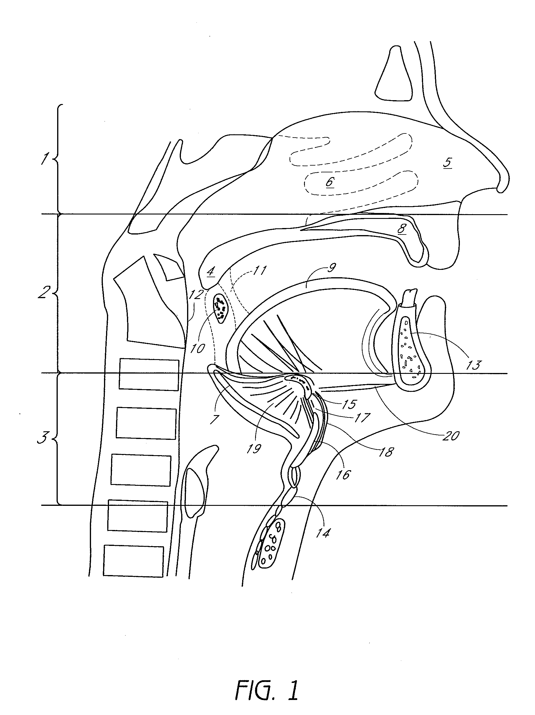 System and method for temporary tongue suspension