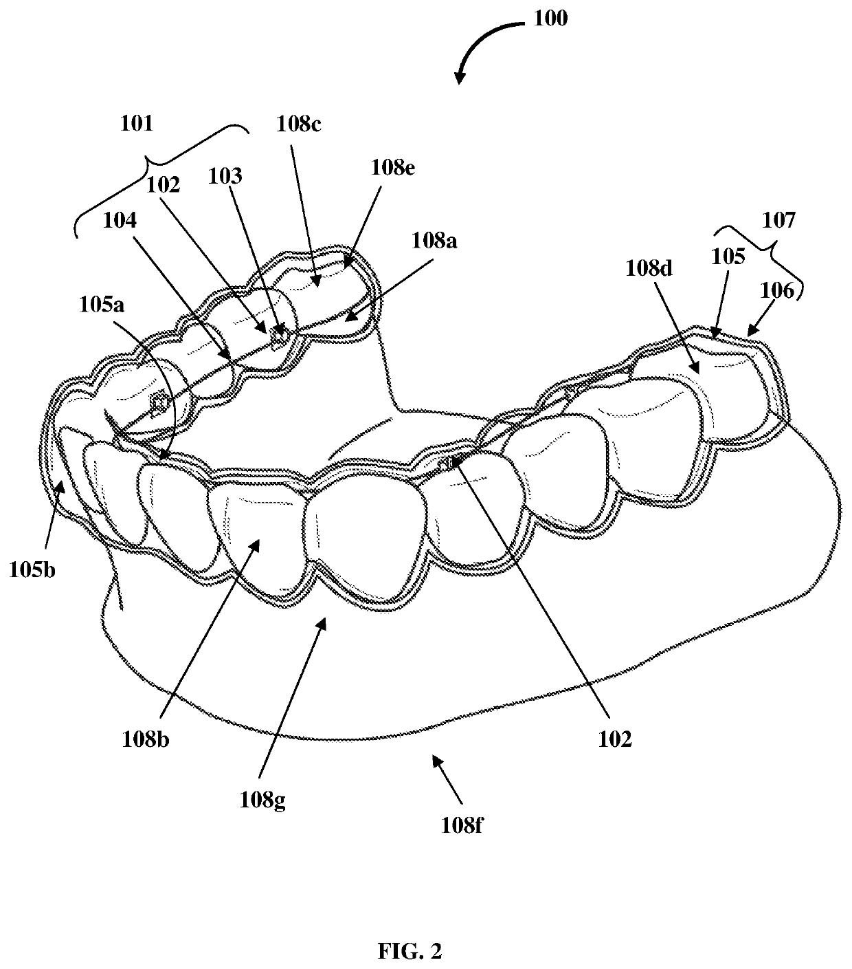 Detachable Orthodontic Bracket And Wire System